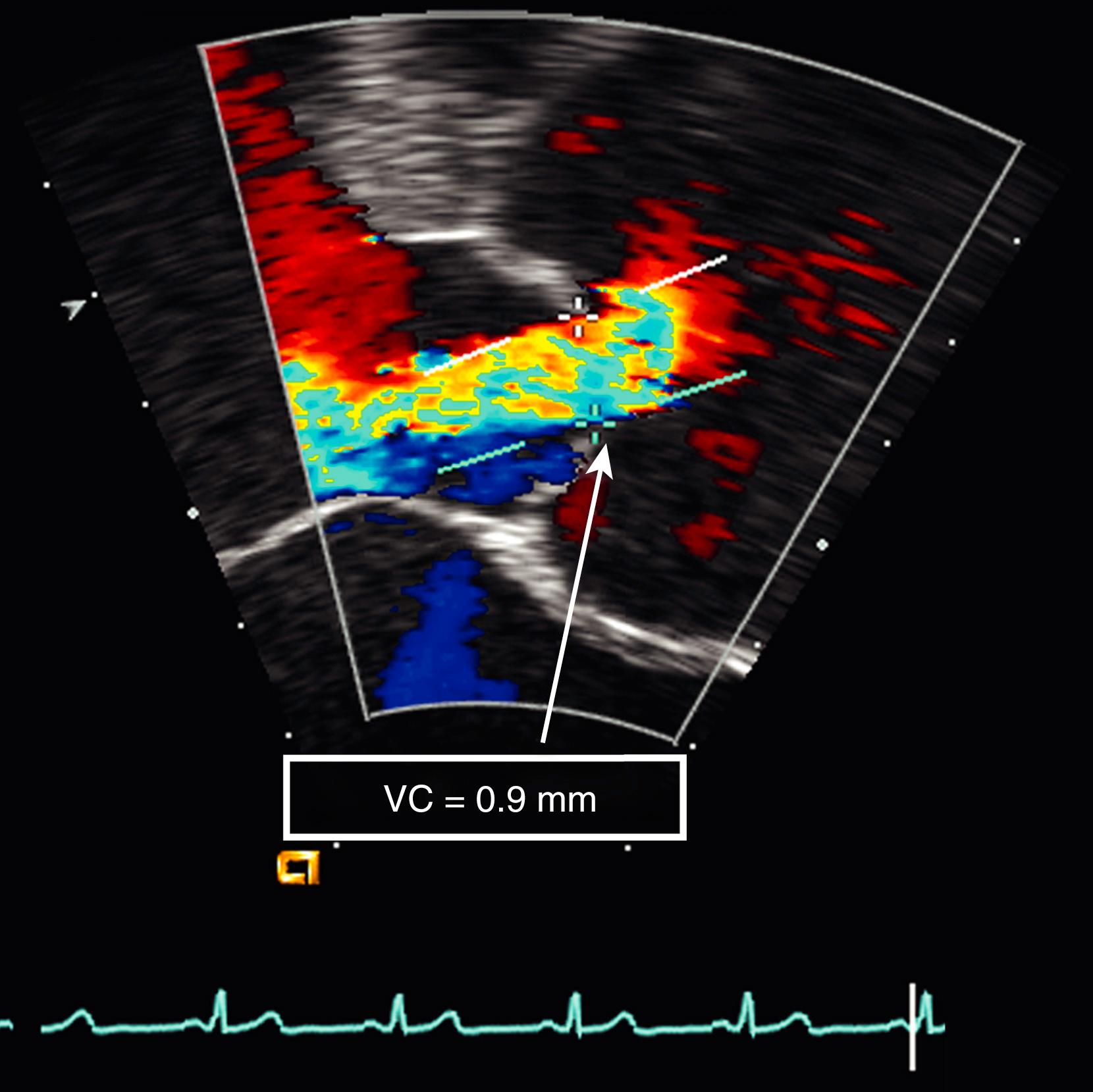 Figure 88.2, Vena contracta (VC) width (9 mm) measurement in a patient with chronic severe aortic regurgitation on transesophageal study.