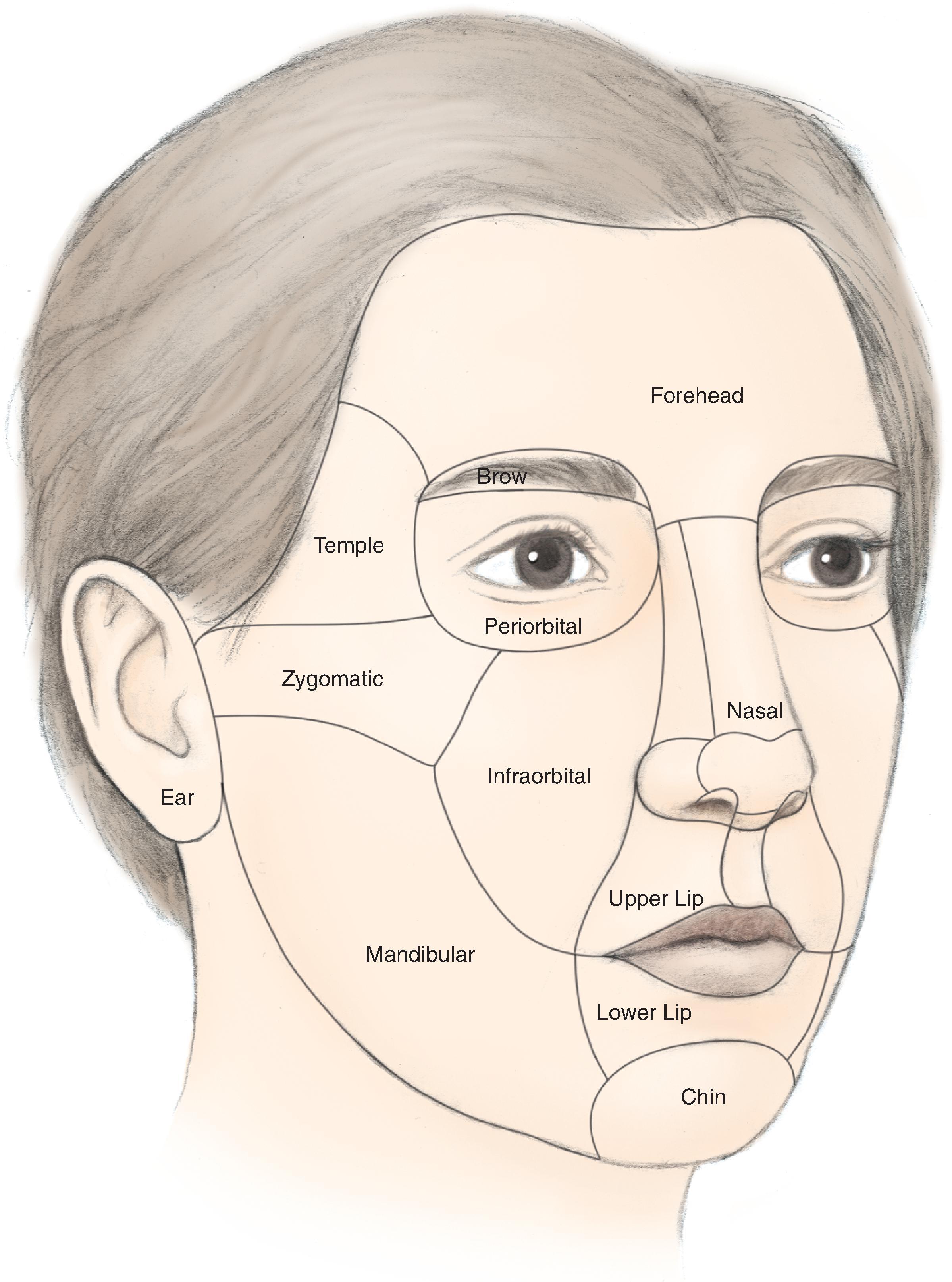Fig. 20.1, Aesthetic boundaries of cheek aesthetic region: inferior bony orbital rim, nasofacial sulcus, melolabial crease, labiomandibular crease, inferior border of mandible, preauricular crease, and line from lateral canthus to root of helix. Aesthetic region of cheek based on inherent mobility and thickness of skin may be divided into units: infraorbital (medial, buccal), zygomatic, and mandibular (lateral).