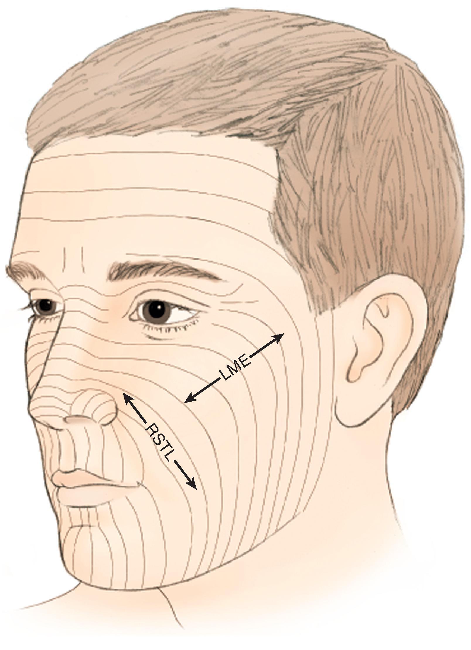 FIG. 20.2, Configuration of relaxed skin tension lines (RSTLs), which are perpendicular to lines of maximal extensibility (LME). Elliptical excisions parallel to RSTLs result in less wound closure tension because skin recruitment is in axis of LME.
