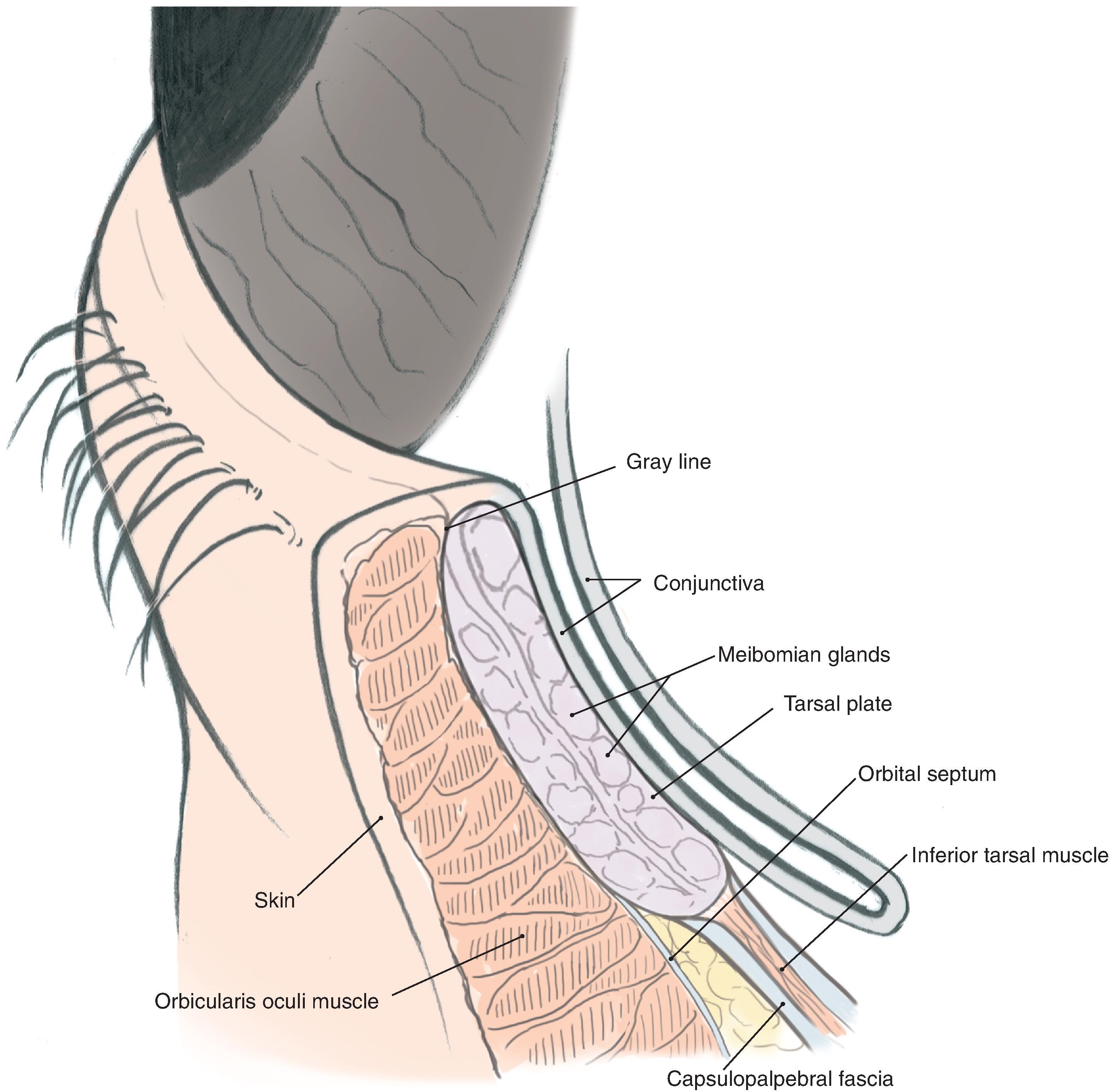 FIG. 17.2, Anatomy of the lower eyelid.