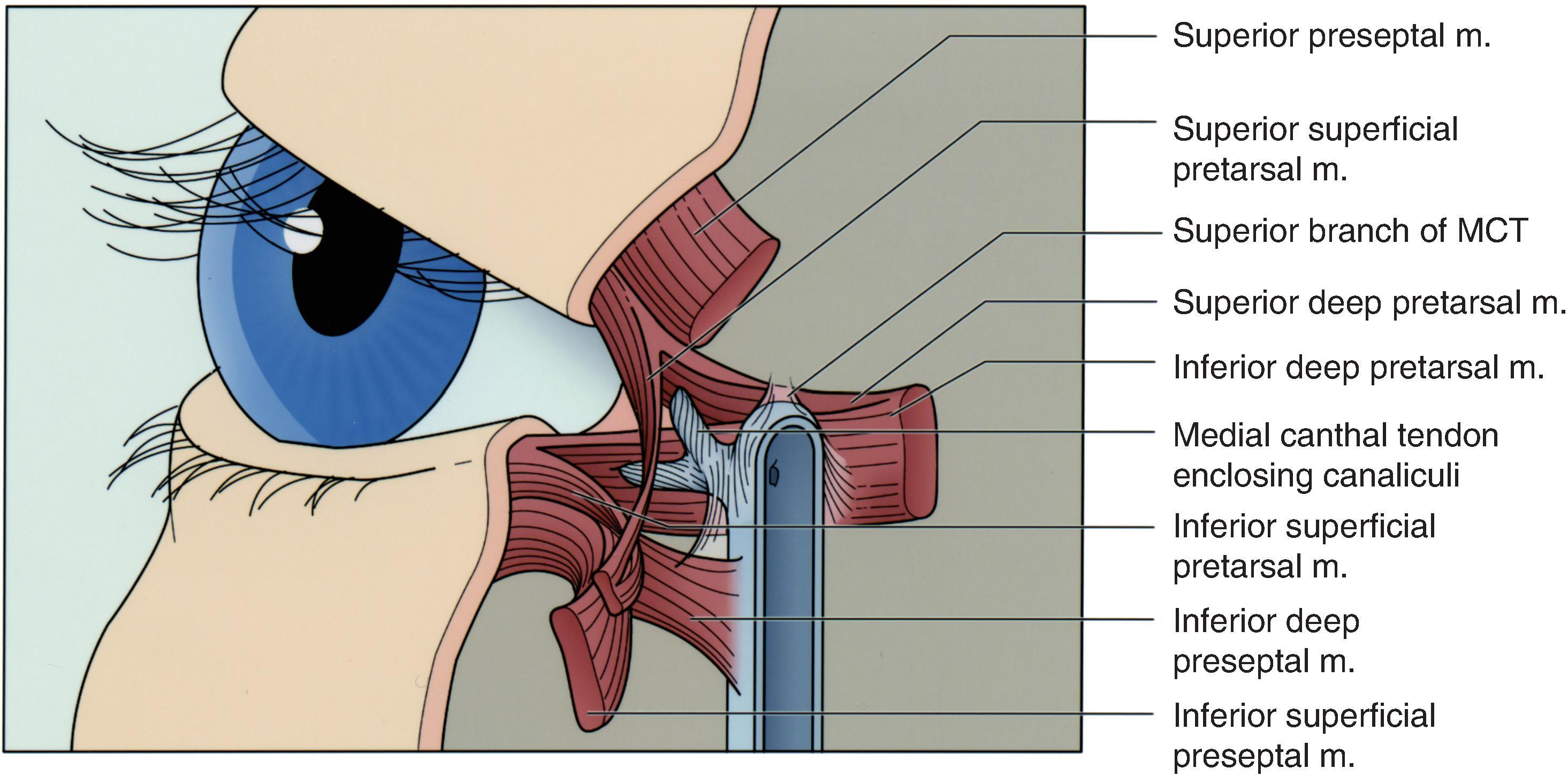 FIG. 17.3, Anatomy of the medial canthus. MCT, medial canthal tendon.