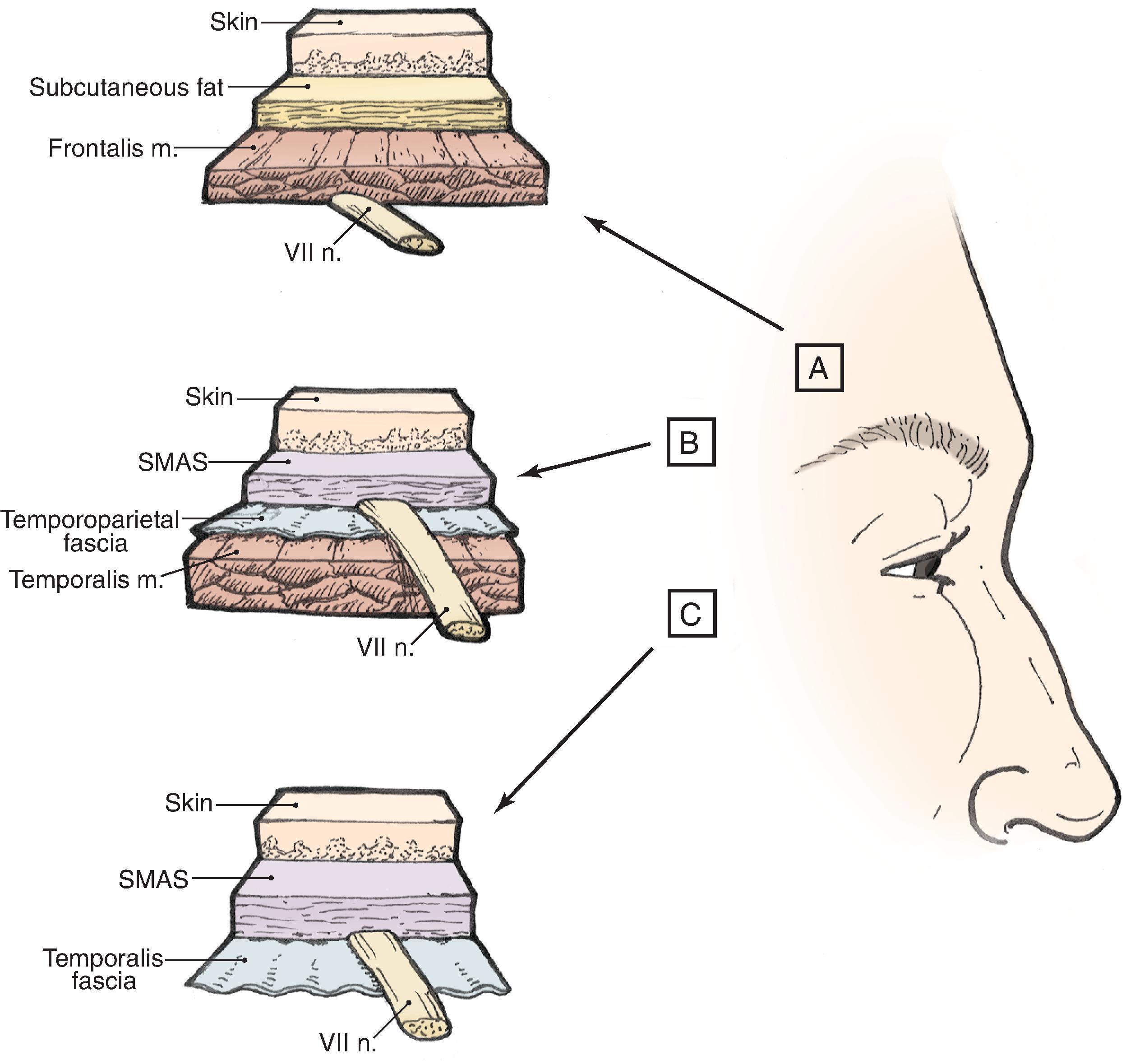 Fig. 21.1, Pathway of temporal branch of seventh cranial nerve in relationship to subcutis, fascia, and muscle. Area C is highest risk for nerve injury because of proximity of nerve to overlying skin.