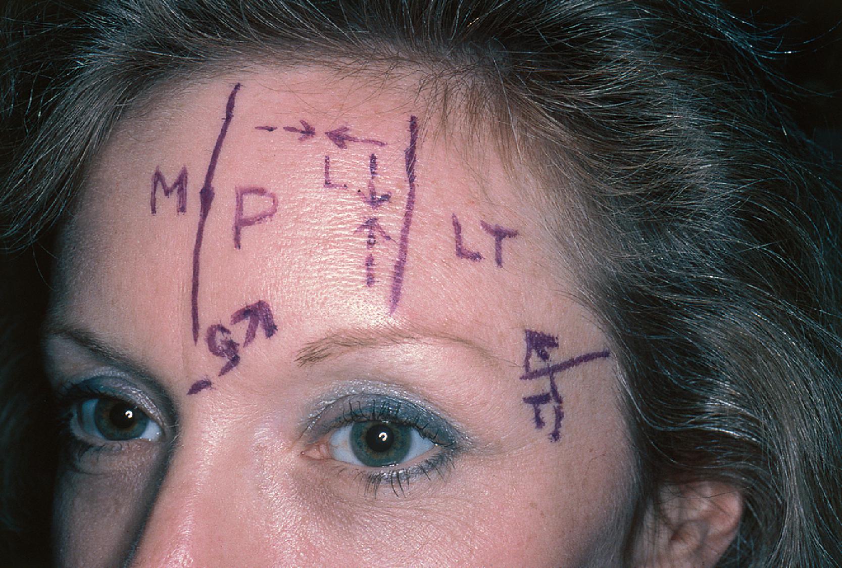 FIG. 21.2, Forehead aesthetic region defined by junction lines with frontal scalp superiorly, temporal scalp and temple laterally, and eyebrows and glabella inferiorly. Reconstruction of forehead skin defects is facilitated by dividing aesthetic region into 3 units: midline (M), paramedian (P), and lateral (LT). Sources of skin for construction of local flaps for repair of forehead defects include local (L), glabella (G), and temple (T).