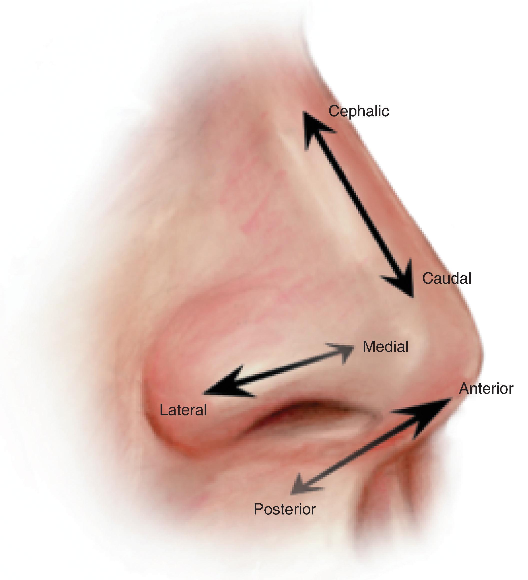 Fig. 18.1, Directional nomenclature of nose. (From Jewett BS: Anatomic considerations. In Baker SR [ed]: Principles of Nasal Reconstruction, 2nd ed. Springer, 2011, p 14, Fig. 2.1, with permission.)