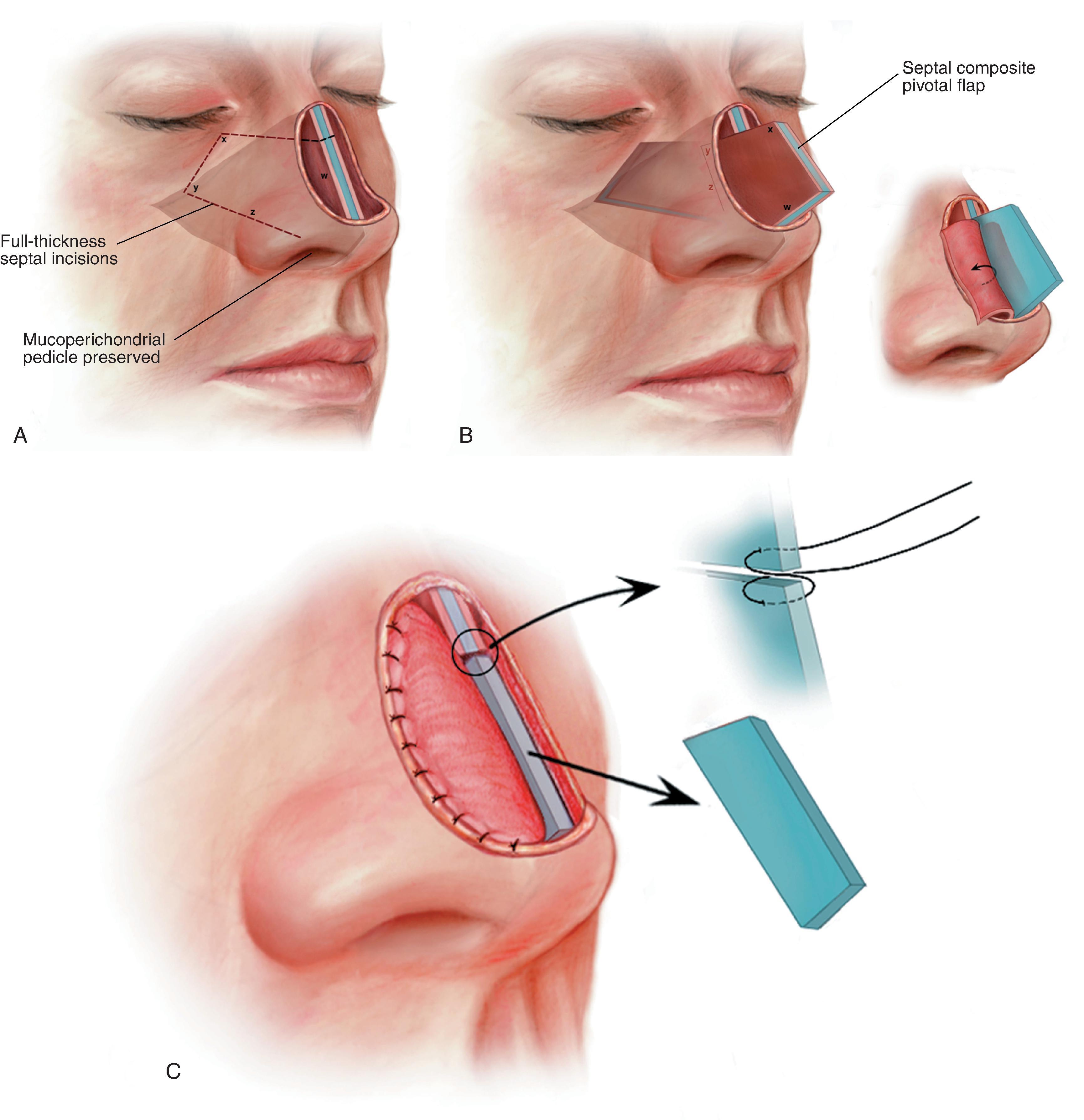 FIG. 18.11, A , Broken line indicates full-thickness incision through septal cartilage, bone, and bilateral mucosa to create composite septal chondromucosal pivotal flap. B , Cephalic aspect of pivoted flap locked into place by abutting against remaining nasal bony septum. Bilateral mucoperichondrial flaps reflected laterally to provide lining to nasal passage. C , Excess septal cartilage and bone trimmed, mucoperichondrial flaps sutured to borders of lining defect. Figure-eight suture fixes composite flap to remaining nasal bony septum. (From Baker SR: Internal lining. In Baker SR [ed]: Principles of Nasal Reconstruction, 2nd ed. Springer, 2011, p 42, Fig. 4.11, with permission.)