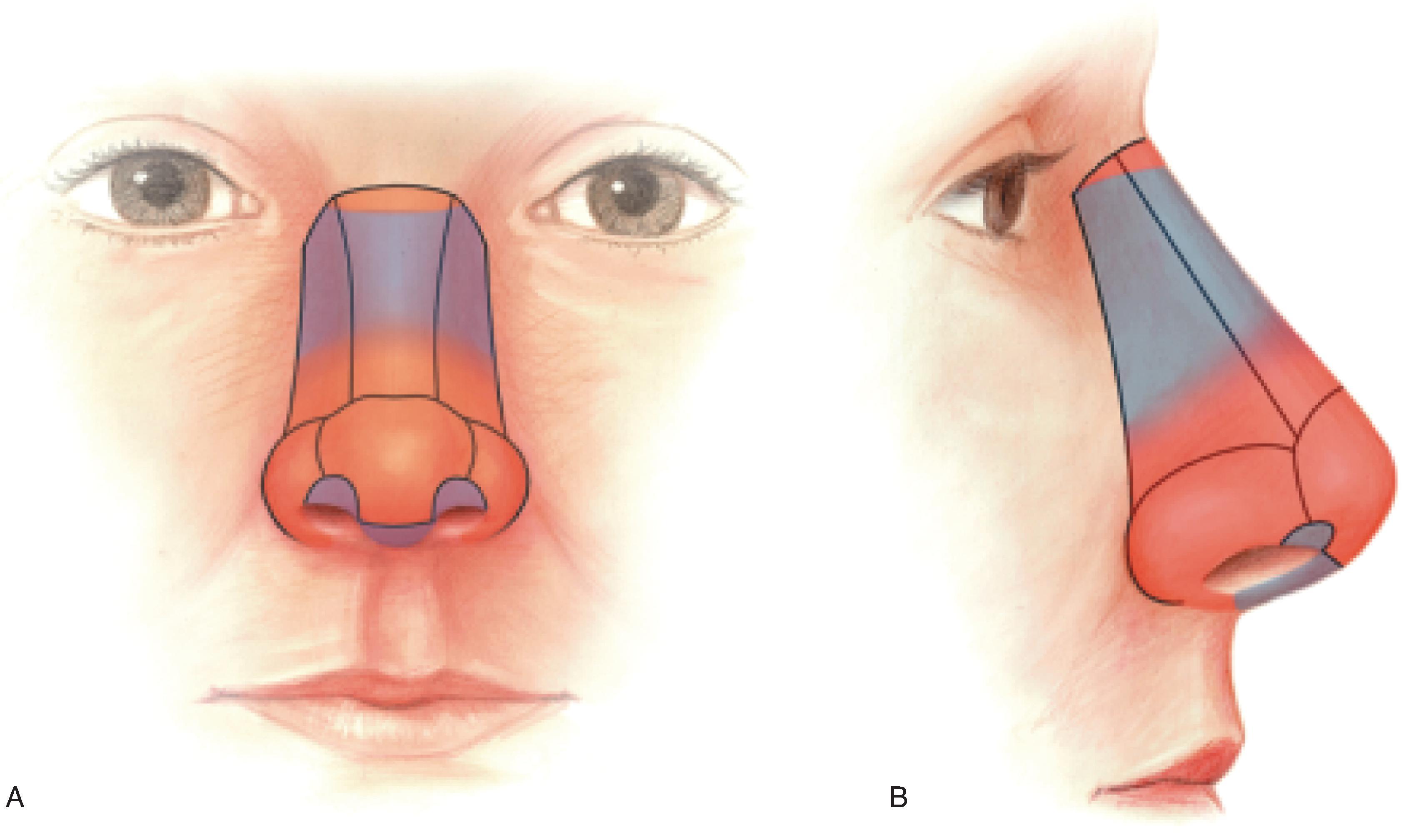 FIG. 18.2, A , B , Aesthetic units of nose. Blue represents thin-skinned regions; red represents thicker skinned regions. (From Jewett BS: Anatomic considerations. In Baker SR [ed]: Principles of Nasal Reconstruction, 2nd ed. Springer, 2011, p 15, Fig. 2.2, with permission.)