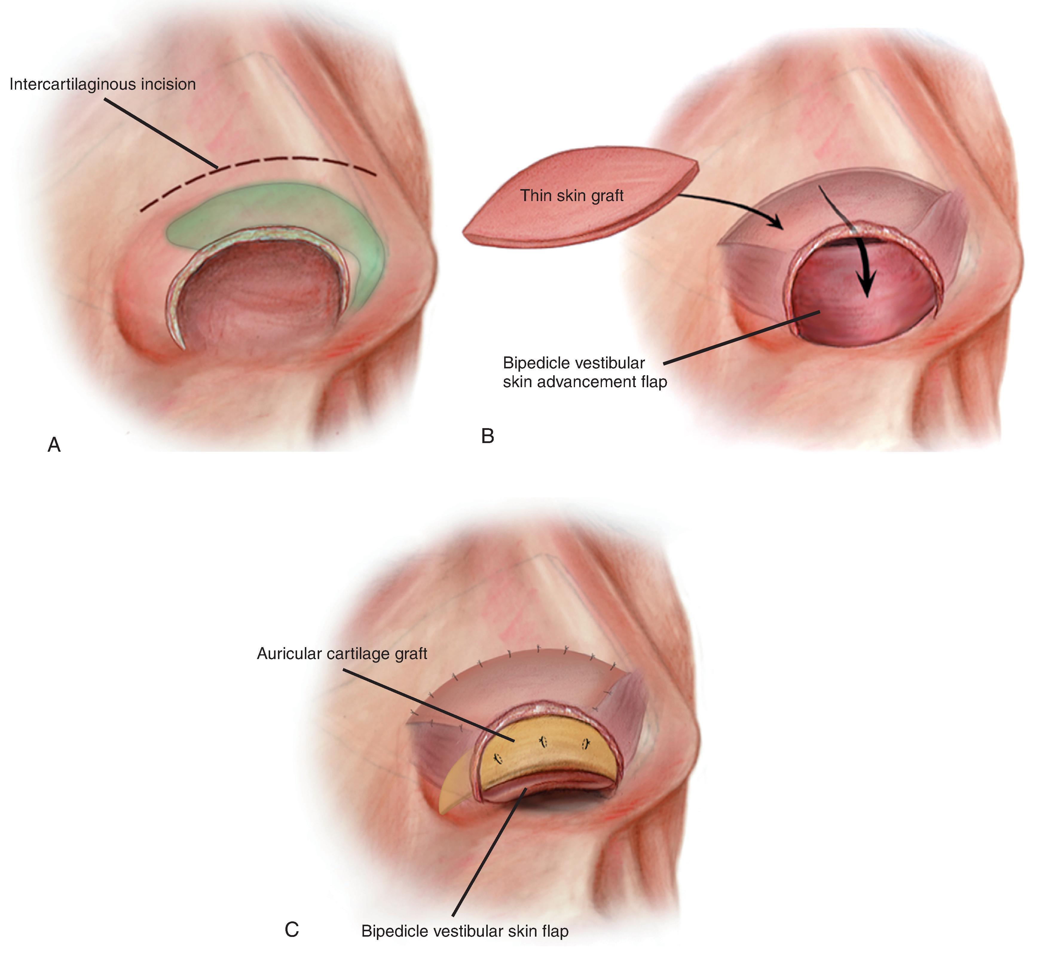 FIG. 18.5, A , Bipedicle vestibular skin advancement flap created by making an intercartilagenous incision between upper and lower lateral cartilages. B , Flap mobilized sufficiently to allow caudal border to reach nostril margin. Thin full-thickness skin graft used to repair flap donor site. C , Auricular cartilage graft provides framework for nostril margin. Lining flap secured to cartilage graft with mattress sutures. (From Baker SR: Internal lining. In Baker SR [ed]: Principles of Nasal Reconstruction, 2nd ed. Springer, 2011, p 32, Fig. 4.2, with permission.)