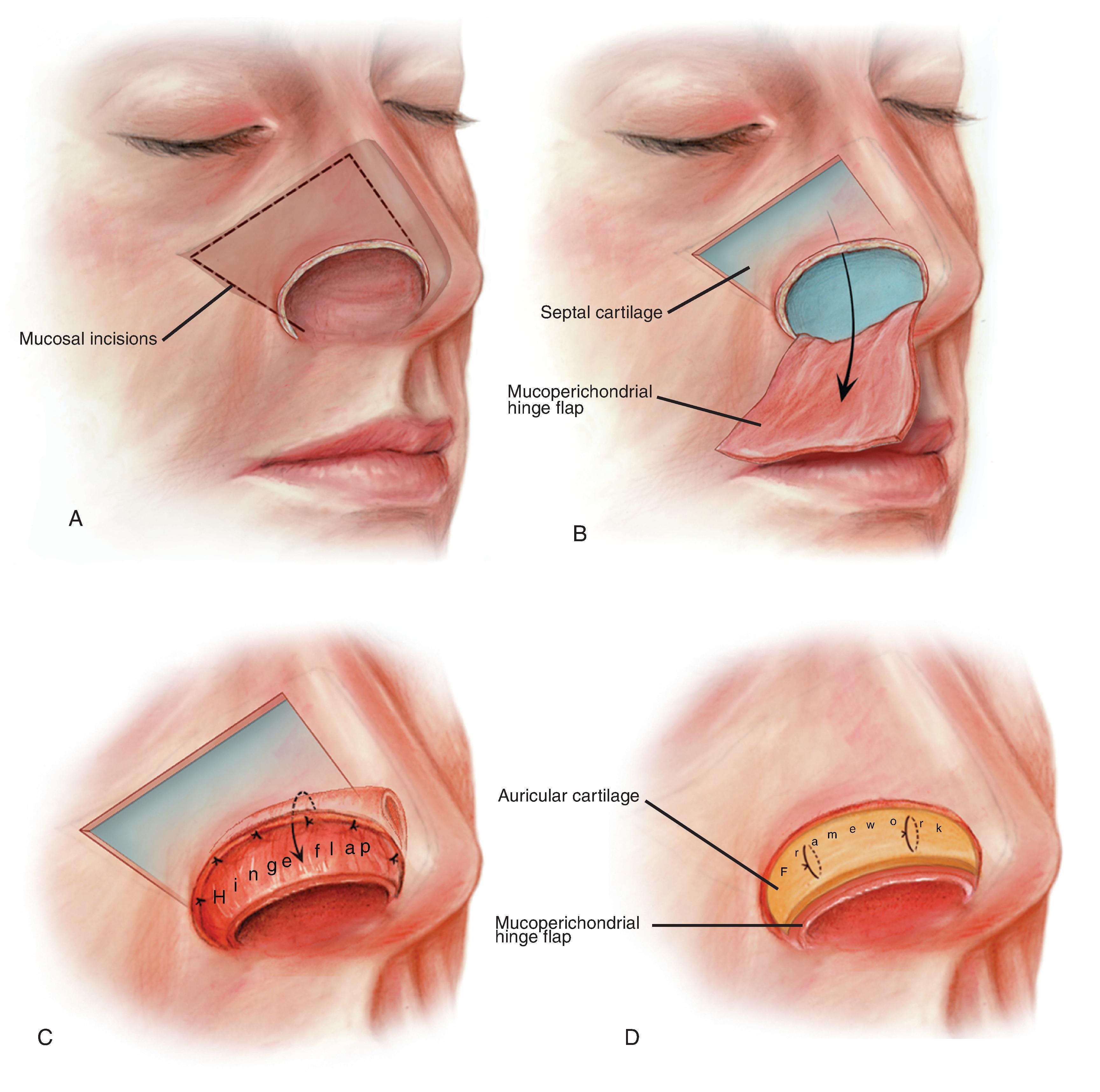 FIG. 18.6, A , Unipedicle septal mucoperichondrial hinge flap developed by incising through mucosa and perichondrium along floor of nose and 1.5 cm below and parallel to cartilaginous dorsum. Incisions extend posteriorly beyond septal bony cartilaginous junction. B , Flap dissected from superior to inferior and anterior to posterior. Anterior dissection remains 1 cm posterior to caudal border of septum and 1.5 cm posterior to nasal spine. Flap based on intact mucoperichondrium of caudal septum and septal branch of superior labial artery. C , Hinged on caudal septum, flap is reflected laterally to line lower nasal vault. D , Cartilage graft provides nasal framework. Lining flap secured to framework with mattress sutures. (From Baker SR: Internal lining. In Baker SR [ed]: Principles of Nasal Reconstruction, 2nd ed. Springer, 2011, p 34, Fig. 4.4, with permission.)