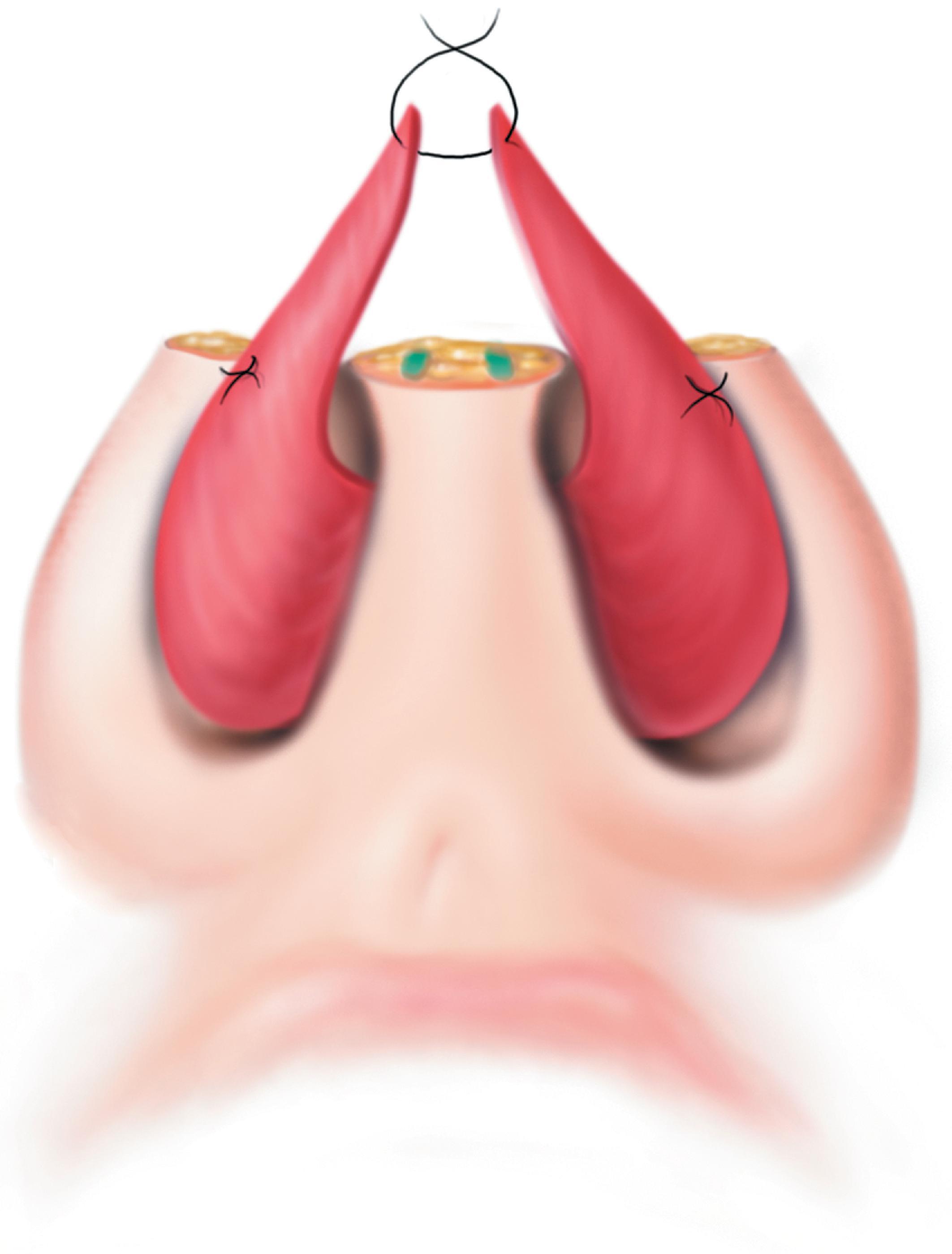 FIG. 18.7, Bilateral caudally based septal mucoperichondrial hinge flaps. Flaps used to line bilateral full-thickness nasal tip defects with intact columella. (From Baker SR: Intranasal flaps. In Baker SR [ed]: Principles of Nasal Reconstruction, 2nd ed. Springer, 2011, p 235, Fig. 11.14, with permission.)