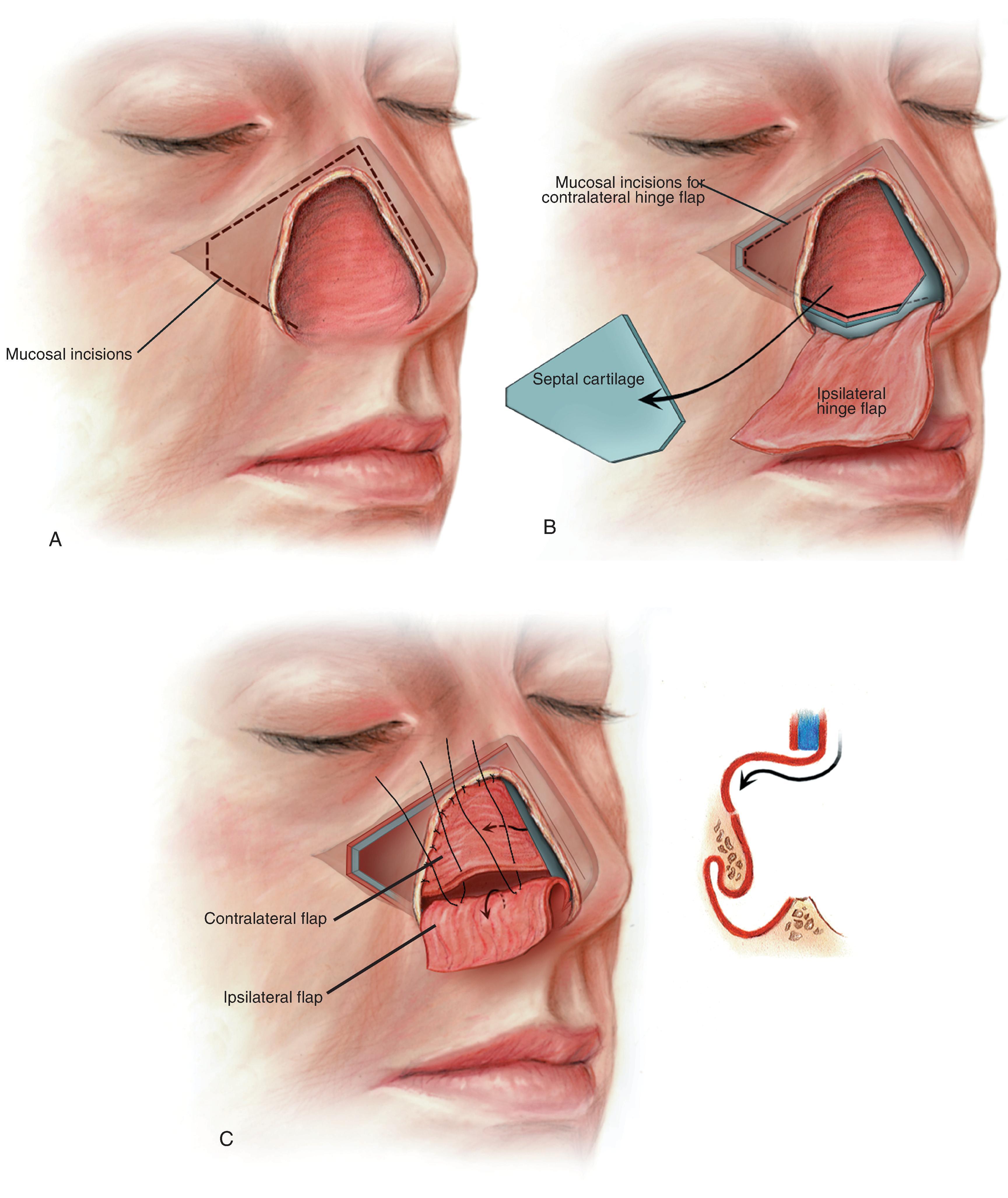 FIG. 18.8, A , Broken line indicates incision for ipsilateral septal mucoperichondrial flap. B , Flap reflected outward and exposed septal cartilage removed. Broken and solid line indicates incisions used to create contralateral dorsal septal mucoperichondrial hinge flap. C , Dorsally based flap reflected laterally and sutured to borders of middle vault lining defect. Caudal border of flap sutured to raw surface of ipsilateral flap to seal nasal passage from exterior. D , Caudally based hinge flap provides lining for lower nasal vault; contralateral dorsally based hinge flap provides lining for middle and upper nasal vaults. E , Septal cartilage ( blue ) provides framework for middle nasal vault; auricular cartilage ( yellow ) provides framework for lower nasal vault. Cartilage grafts scored to create desired convex contour. Lining flaps attached to framework with mattress sutures. F , Nasal framework covered by paramedian forehead flap. (From Baker SR: Internal lining. In Baker SR [ed]: Principles of Nasal Reconstruction, 2nd ed. Springer, 2011, pp 36-37, Fig. 4.7, with permission.)