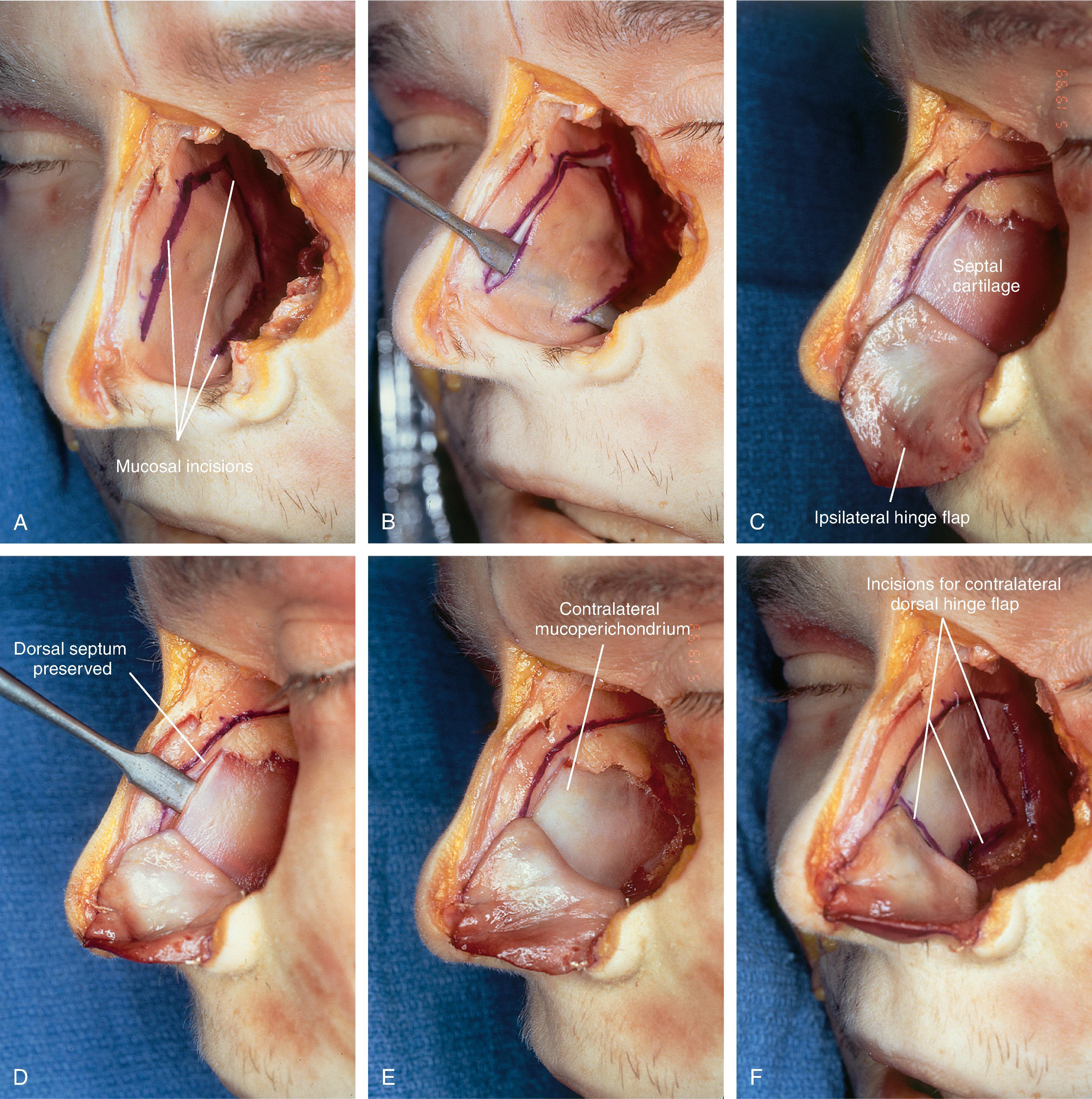 FIG. 18.9, A , Outline of ipsilateral mucoperichondrial hinge flap. Dorsal incision is parallel and 1 cm below attachment of upper lateral cartilage to nasal septum. Inferior incision extends along junction of nasal crest with cartilaginous septum. B , Flap is elevated in subperichondrial plane from anterior to posterior. C , Mucoperichondrium based on caudal septum is reflected laterally as hinge flap. D , Exposed septal cartilage is freed from contralateral mucoperichondrium. L-shaped strip of septal cartilage 1 to 1.5 cm wide is preserved dorsally and caudally to support middle and lower nasal vaults. E , Septal cartilage removed for grafting purposes. Contralateral mucoperichondrium remains intact. Exposed bony septum may be removed or left in place. F , Contralateral dorsal septal mucoperichondrial hinge flap outlined. The majority of contralateral mucoperichondrium is incorporated in flap. Flap is created by two vertical and one inferior horizontally oriented incisions. G , Flap incised and reflected laterally. H , Flaps sutured in position. Caudal edge of contralateral flap is tacked to exposed raw submucosal surface of ipsilateral flap to seal off nasal passage from exterior. I , Ipsilateral flap is reflected laterally to line lower nasal vault. Suture suspension of flap to overlying cartilaginous framework (not yet in place) restores arc of nasal vestibule. (From Baker SR: Intranasal flaps. In Baker SR [ed]: Principles of Nasal Reconstruction, 2nd ed. Springer, 2011, pp 215-216, Fig. 11.2, with permission.)