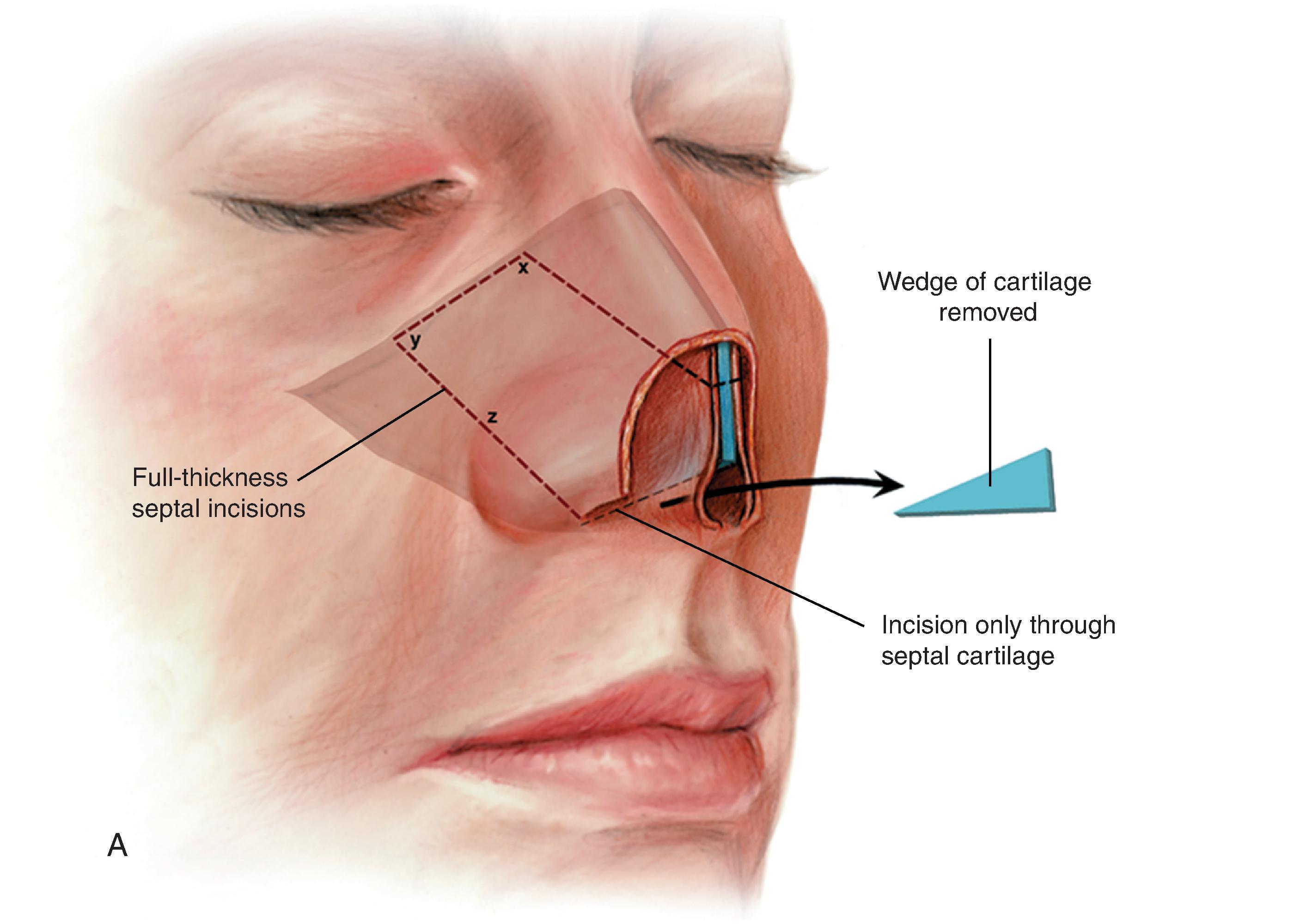 FIG. 18.10, A , Bold broken line indicates full-thickness incision through septal cartilage, bone, and bilateral mucosa to create composite septal chondromucosal pivotal flap. Faint broken line indicates incision made only through septal cartilage, preserving overlying mucoperichondrium. Wedge of cartilage removed to enable flap to pivot anterocaudally. B , Cephalic aspect of pivotal flap locked into place by abutting it against remaining cartilaginous dorsum. Bilateral mucoperichondrial flaps reflected laterally to provide lining for nasal tip. C , Excess septal cartilage trimmed. Reflected mucoperichondrial flaps sutured to borders of lining defect. D , Auricular cartilage graft ( yellow ) provides bilateral framework for nasal tip, replacing missing lateral crura. Septal cartilage ( blue ) of composite flap serves as medial crura for reconstruction. Mucoperichondrial flaps attached to framework with mattress sutures. (From Baker SR: Internal lining. In Baker SR [ed]: Principles of Nasal Reconstruction, 2nd ed. Springer, 2011, p 39, Fig. 4.9, with permission.)