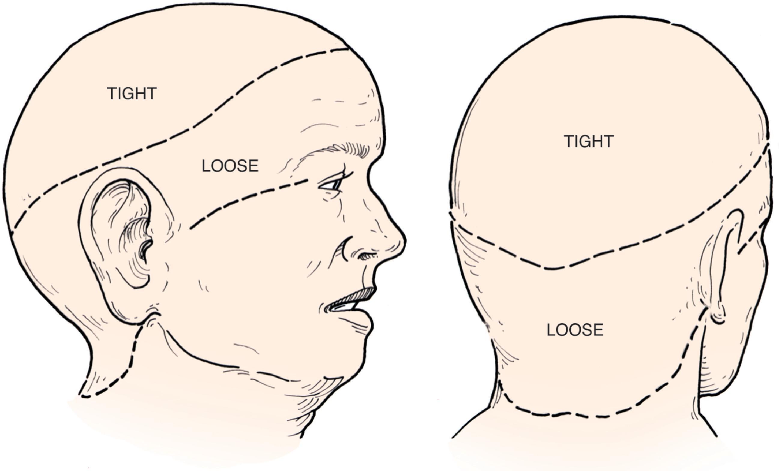 FIG. 24.3, A , B , Tight and loose regions of the scalp. Tight region has dense galeal layer, no underlying muscle, and poor distensibility. In loose regions, galea is a thin fascial layer overlying muscle and scalp is more distensible.