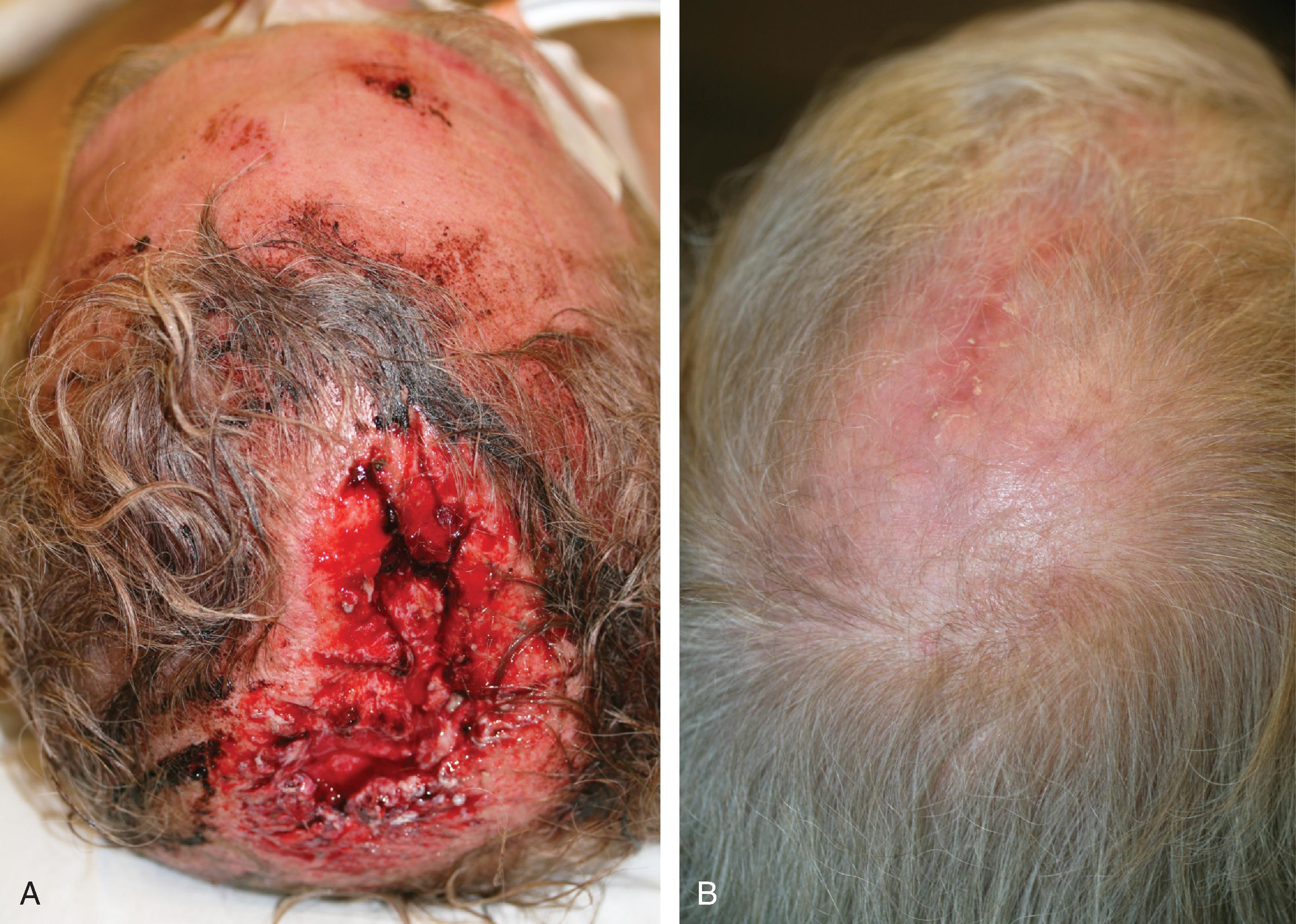 FIG. 24.6, A , Extensive traumatic wound of vertex of scalp. B , Wound closed primarily by bilateral wide undermining of scalp in subgaleal plane, as well as some healing by secondary intention.