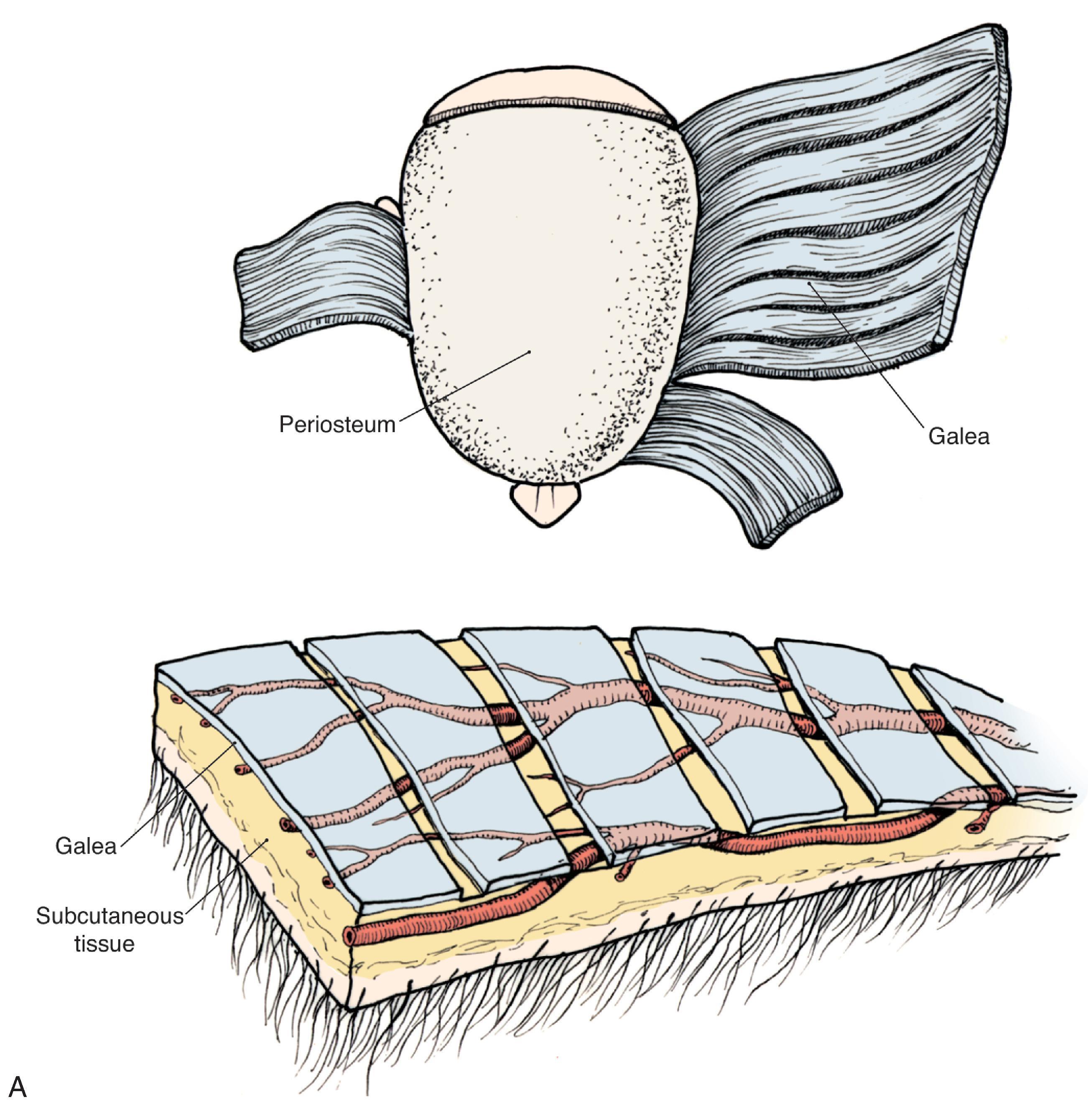 FIG. 24.7, Galeal relaxing incisions allow greater stretching of the scalp tissue. Incisions are made cautiously to avoid major vessels. A , Artists depiction. B , Intraoperative view.