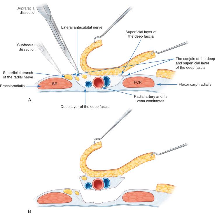 Figure 47.6, Suprafascial dissection of the radial forearm flap.