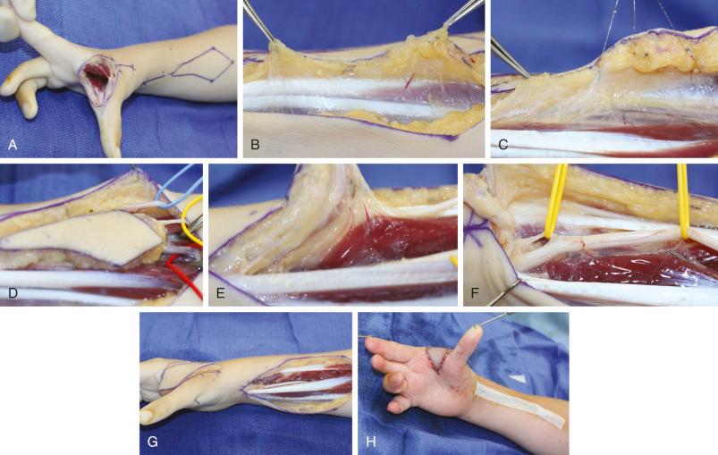 Figure 47.7, Technique of flap harvesting.