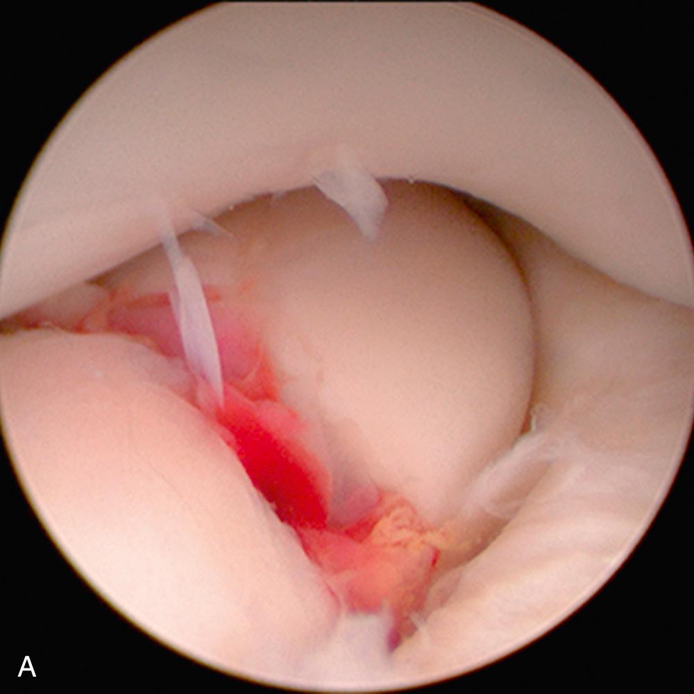 FIG 38.6, (A) Posterior arthroscopic view of a radial head fracture. (B) Arthroscopic fixation with a headless screw. Note the large cartilage defect at the posterior aspect of the capitellum. This fragment was interposed between the fracture fragments, causing a block to rotation.