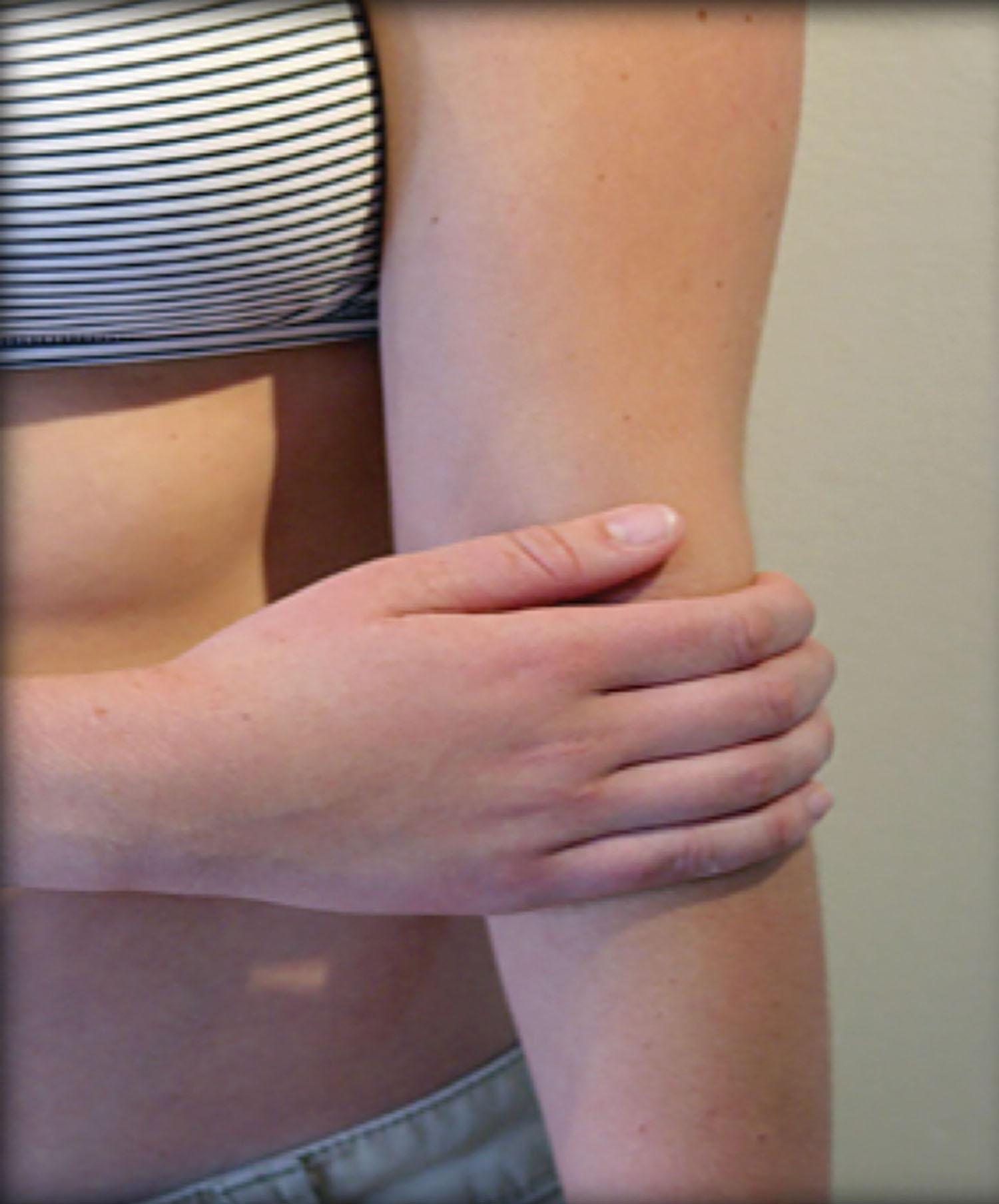 Figure 15.3, Patient identiﬁcation of elbow pain, consistent with radial tunnel entrapment.