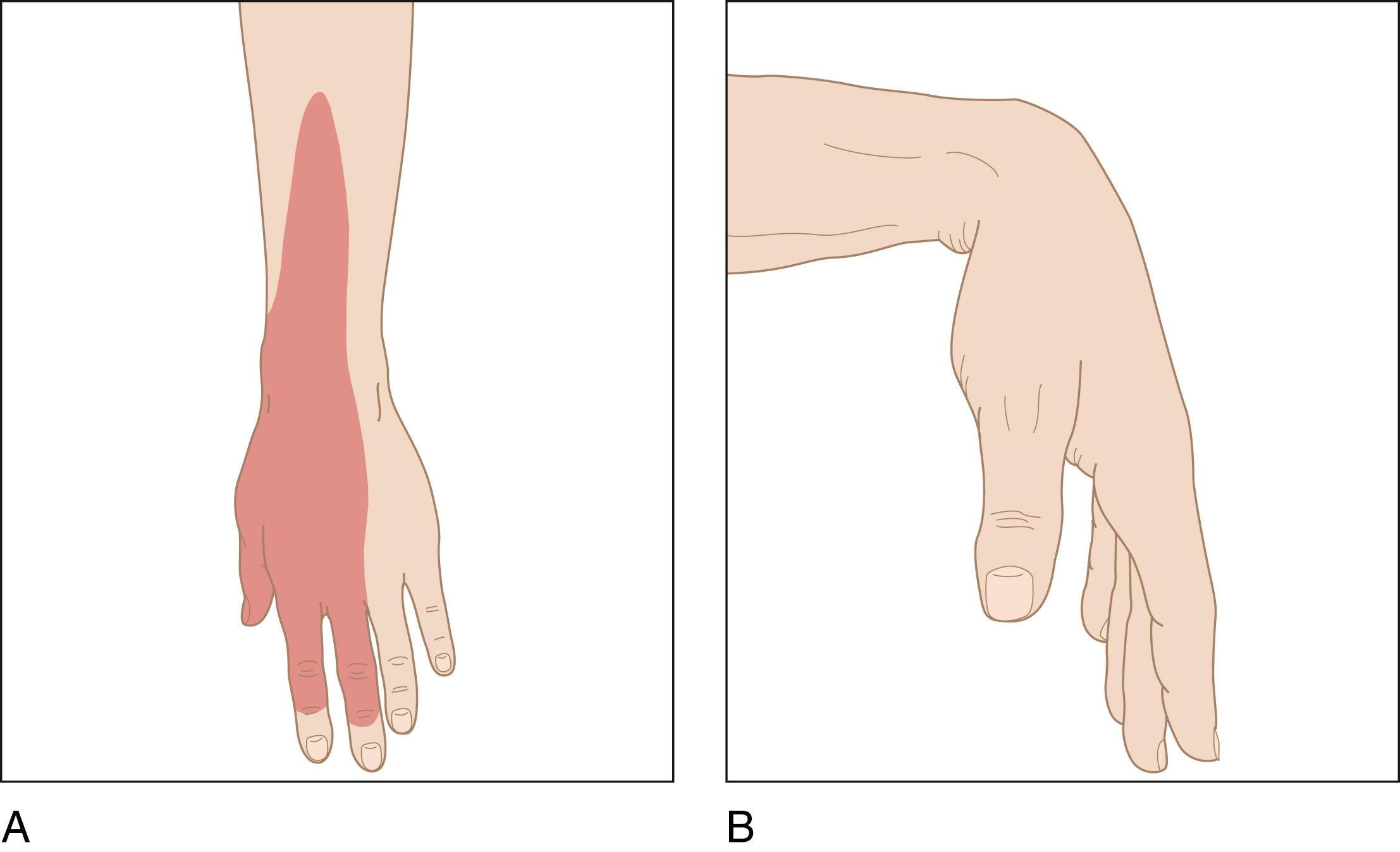 Fig. 126.1, (A) Decreased or absent sensation on the radial and dorsal sides of the hand and wrist. (B) Hand will drop when positioned palm down.