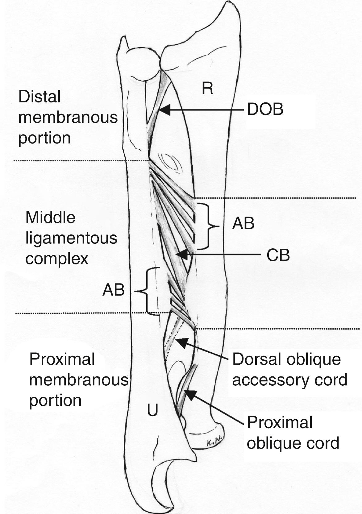 Fig. 58.1, Depiction of the structure of the interosseus membrane anatomy. AB , Accessory band; CB , central band; DOB , distal oblique bundle; R , radius; U , ulna.