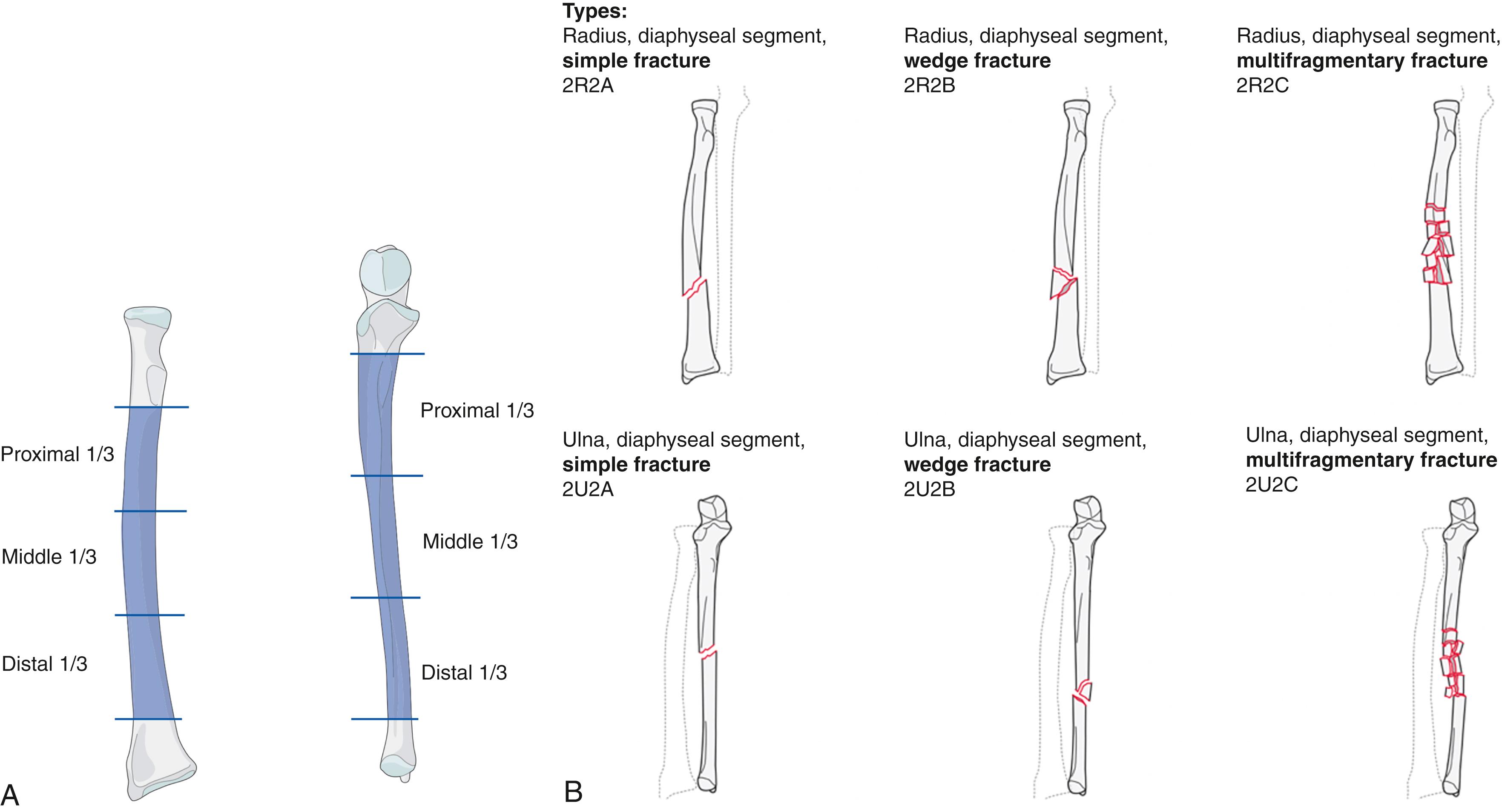 Fig. 58.2, (A) The diaphysis of the radius and ulna is divided into the proximal 1/3, middle 1/3, and distal 1/3. There is no uniformly agreed-upon classification for fractures of the diaphysis of the radius and ulna. (B) AO classification fractures of the diaphysis of the ulna and radius.