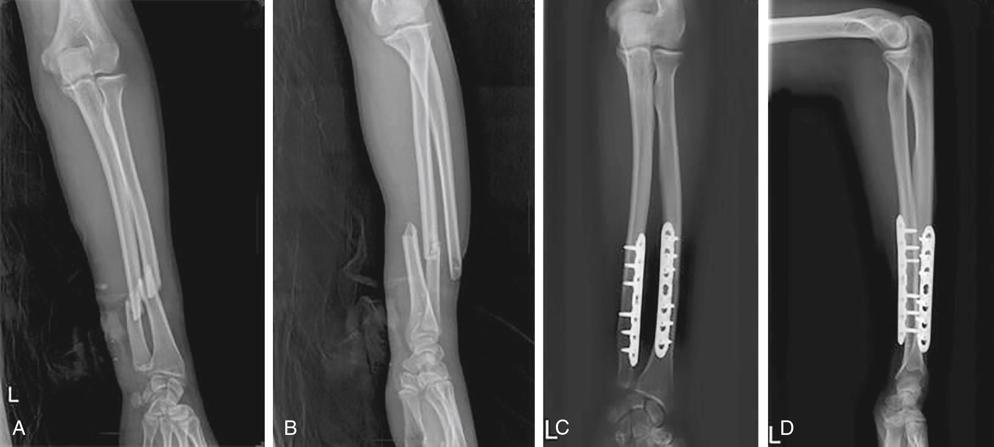 Fig. 58.3, Radiographs (A) and (B) are of a 26-year-old male with a diaphyseal both bone forearm fracture. (C) and (D) demonstrate union following open reduction internal fixation after compression plating.