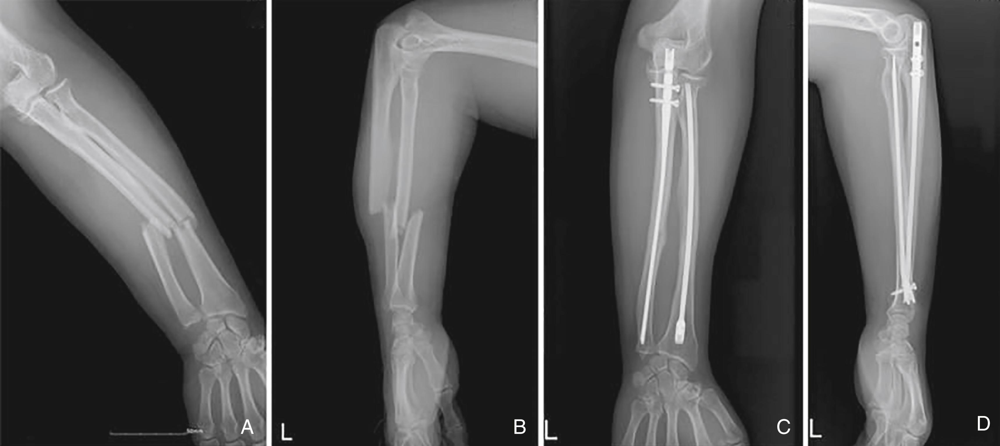 Fig. 58.4, Radiographs (A) and (B) are of a 56-year-old female with a diaphyseal both bone forearm fracture. (C) and (D) demonstrate union following intramedullary nailing.