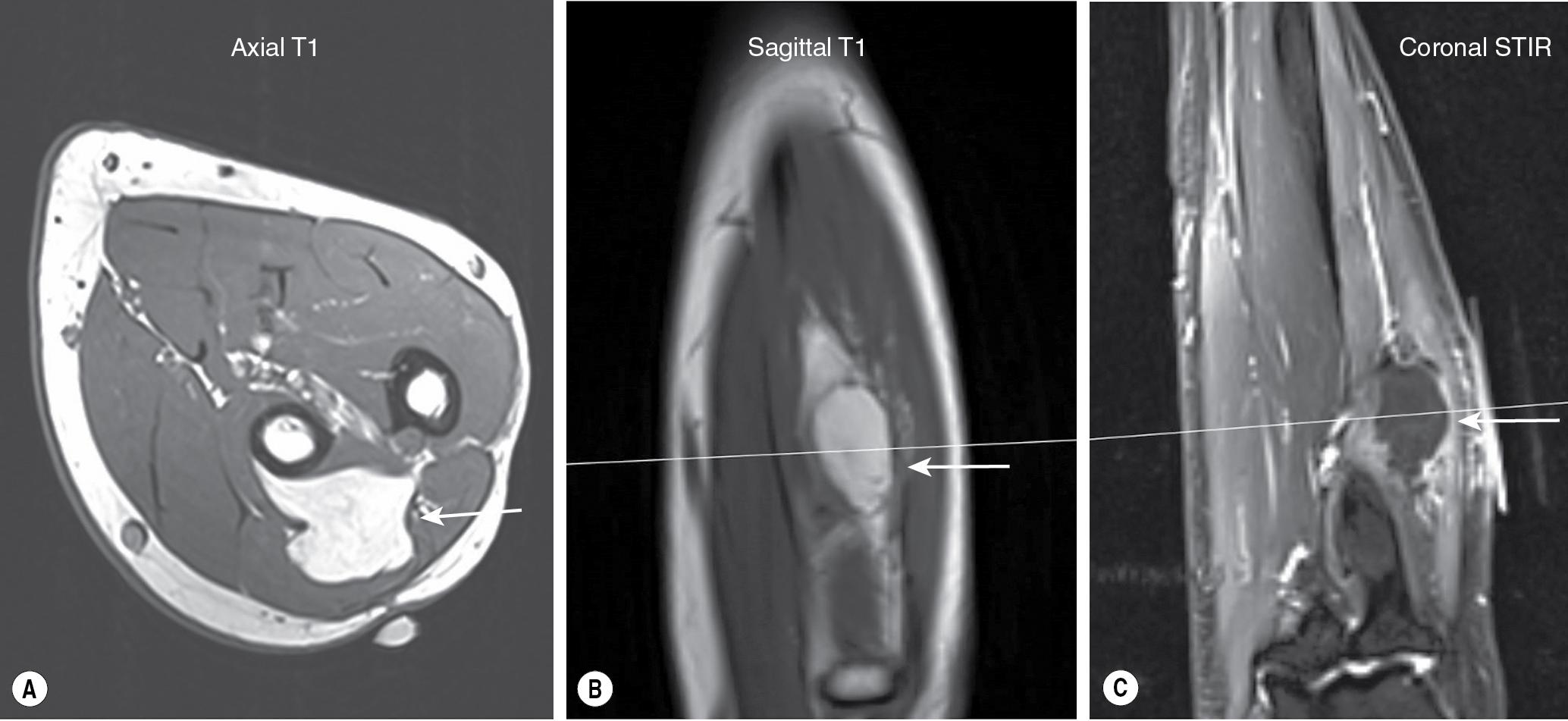 FIGURE 59.1, MRI showing a lipoma in the radial tunnel. (A) Axial T1. (B) Sagittal T1. (C) Coronal STIR. MRI , Magnetic resonance imaging; STIR , short tau inversion recovery.