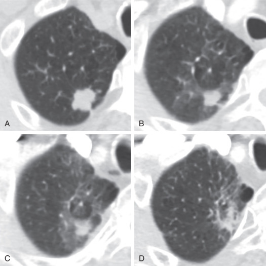 Figure 25.1, A 61-year-old man with stage IA adenocarcinoma of the right upper lobe treated with stereotactic beam radiation therapy. (A) Initial CT scan demonstrates the primary tumor. (B) Follow-up at 3 months shows decrease in tumor size, with subtle surrounding ground-glass opacities (GGOs) representing radiation pneumonitis. (C) At 6 months, the GGOs have increased, and there is now subtle architectural distortion representing the evolution of radiation pneumonitis and fibrosis. (D) Eighteen months after completion of therapy shows resolution of the mass and improvement in the GGOs with progressive fibrosis, including architectural distortion, reticulation, and volume loss.