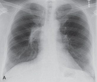 Figure 25.2, A 65-year-old man with radiation fibrosis from treatment of stage IIIA non–small cell lung cancer of the right lung with conventional radiotherapy. (A) Chest radiograph shows characteristic findings of radiation fibrosis, with sharply demarcated consolidation in the right perihilar region and right-sided volume loss. (B) Axial CT images show more fully the sharply marginated fibrosis that crosses fissures and extends anteroposterior along the radiation field. Volume loss with cicatricial atelectasis and traction bronchiectasis are typical findings of radiation fibrosis.