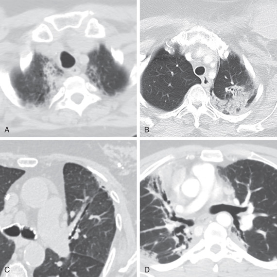 Figure 25.3, Different patterns of radiation fibrosis. (A) Biapical fibrosis in a patient who underwent radiation of the neck for treatment of recurrent papillary thyroid cancer. (B) Unilateral apical fibrosis in a woman with breast cancer with left cervical and axillary nodal metastases treated with radiation. (C) Tangential fibrosis in the anterolateral left lung from breast cancer treated with breast conservation therapy. Also note the metallic tissue marker within the tumor, another clue to the diagnosis. (D) Bilateral paramediastinal radiation for treatment of Hodgkin lymphoma.