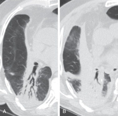 Figure 25.4, A 74-year-old man with unresectable lung cancer and recurrence 4 years after completion of radiation therapy. (A) CT performed 30 months after completion of radiation therapy shows typical findings of radiation fibrosis without recurrence. (B) CT performed 18 months later (48 months after completion of radiation) shows multiple findings of recurrence, including new soft tissue convexity along the lateral radiation margin, opacification of previously dilated bronchi with tumor, and new pleural nodularity.