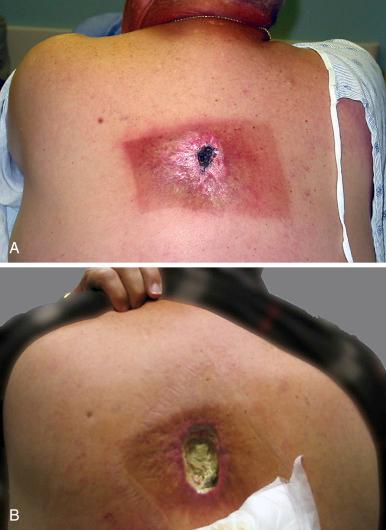 Fig. 7.1, Radiation injury in a 60-year-old man resulting from coronary angioplasty. Images show a time sequence of the injury. (A) At 30 weeks after exposure, a central area of deep necrosis surrounded by indurated and depigmented skin within an area of prolonged erythema is shown. (B) At 38 weeks after exposure, area of deep necrosis has increased in size.