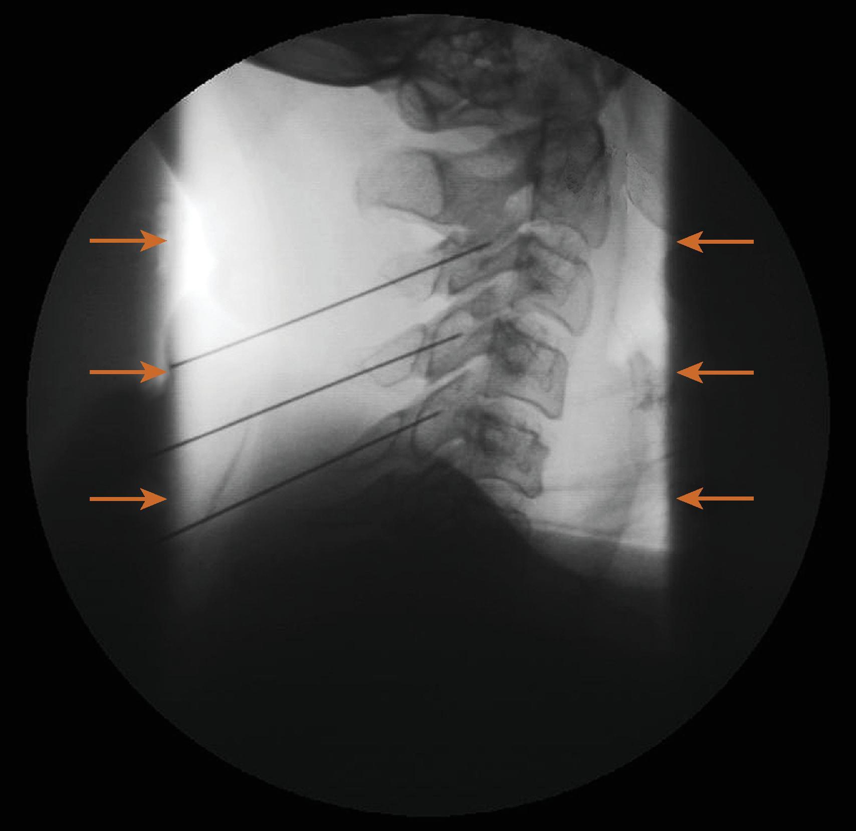 Figure 73.4, Use of adjustable (linear) collimator to decrease radiation exposure to the patient while improving image resolution by decreasing the range of tissue density in the image field.