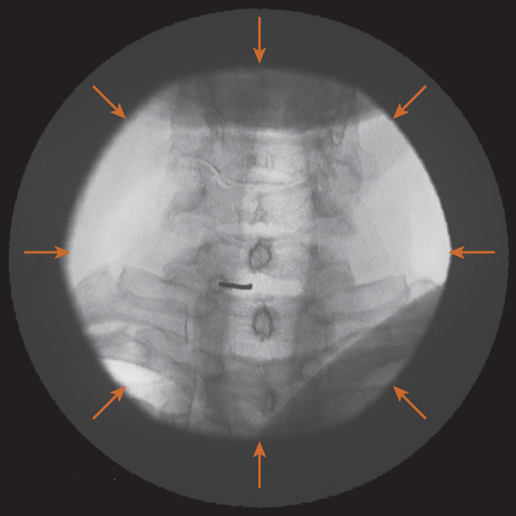 Figure 73.5, The use of an adjustable (iris) collimator to limit the field to the area of interest reduces radiation exposure to the patient and improves image resolution by decreasing the range of tissue density in the image field.