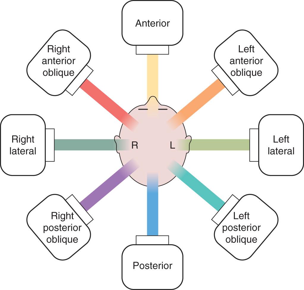 Figure 19.3, Designation of treatment fields (ports).