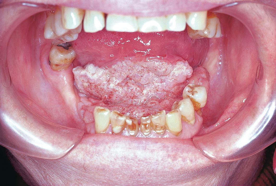 Figure 19.4, Extraction of teeth in the immediate proximity of the tumor should be avoided before surgery.