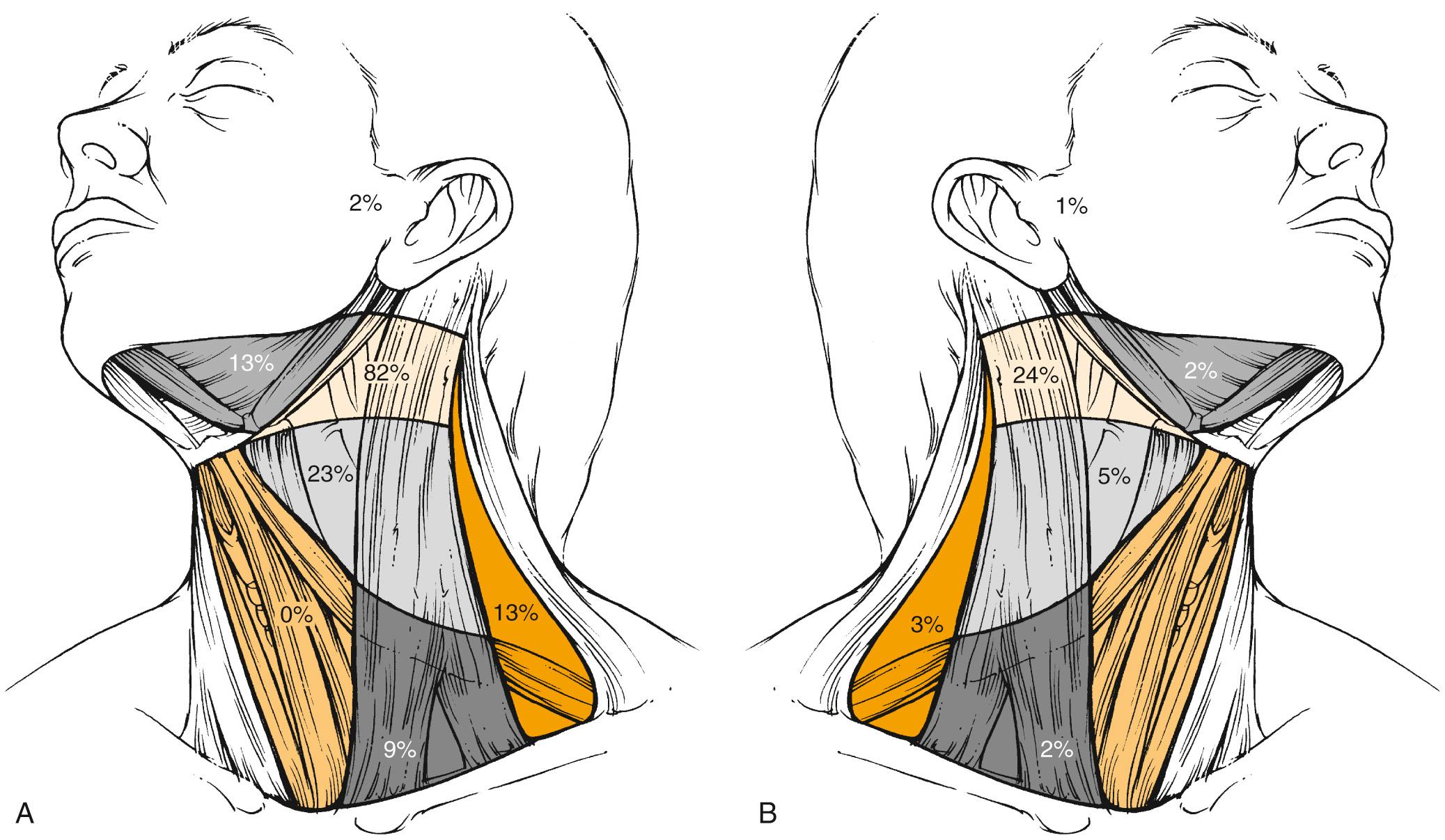 Fig. 117.3, Clinical incidence of metastatic lymph nodes in the neck of patients ( n = 1479) with squamous cell carcinoma of the oropharynx. (A) Ipsilateral neck. (B) Contralateral neck. Data are expressed as a percentage of node-positive patients.