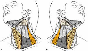 Fig. 117.4, Clinical incidence of metastatic lymph nodes in the neck of patients ( n = 847) with squamous cell carcinoma of the hypopharynx. (A) Ipsilateral neck. (B) Contralateral neck. Data are expressed as a percentage of node-positive patients.