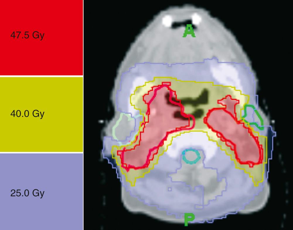 Fig. 117.8, Computed tomography section at the level of C2 with dose distribution from an intensity-modulated radiation therapy plan for a hypopharyngeal T4N0M0 squamous cell carcinoma treated by concomitant chemoradiation. An elective dose of 50 Gy (25 × 2 Gy over 5 weeks) was prescribed to Levels II to IV on both sides of the neck. A total dose of 70 Gy (35 × 2 Gy over 7 weeks) was prescribed to the right piriform sinus. Three courses of cisplatin (100 mg/m 2 ) were given in weeks 1, 4, and 7. The target volumes are marked in red (bold line). The left parotid gland is marked in green, the right parotid is marked in light green, and the spinal cord is marked in blue. The color scale for the dose areas is at left. Sharp dose gradients are created between the target volumes and the normal tissues. A mean dose of 20 Gy was delivered to both parotids. The maximum dose to the spinal cord did not exceed 25 Gy.