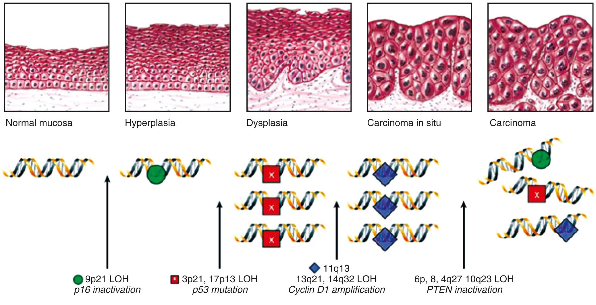 Fig. 110.4, Models have been proposed for a stepwise molecular and morphologic progression to development of invasive head and neck cancer. LOH , Loss of heterozygosity.