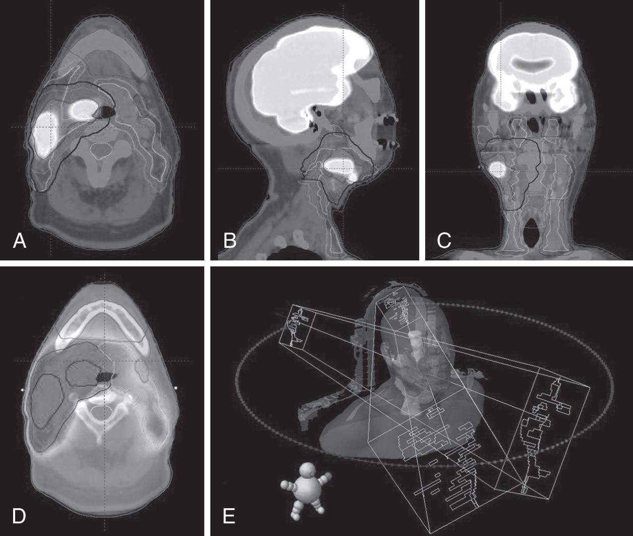 Fig. 22.1, Overview of planning volumes drawn on CT images with PET fusion (A–C) , visualization of expected dose delivery with inner circles being the highest dose (D) , and 3D visualization of beam arcs and shapes with respect to patient (E) . CT , Computed tomography; PET , positron emission tomography.