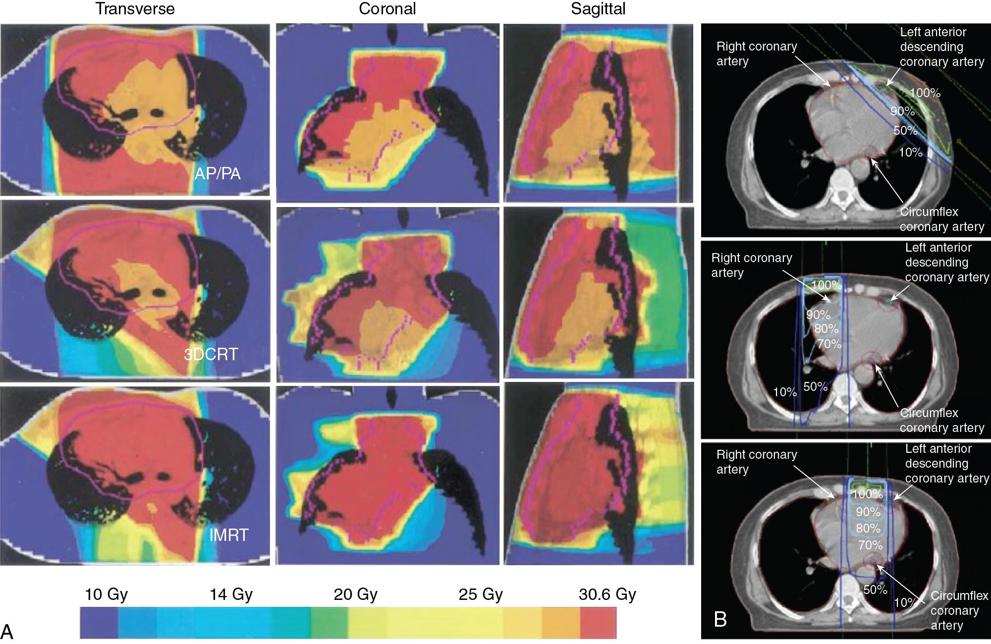 FIG. 4.1, A, Comparison of dose distribution of conventional parallel opposed ( AP/PA ) versus three-dimensional conformal radiation therapy (3- DCRT ) versus intensity-modulated radiation therapy ( IMRT ) plans. (a) Example 1: large volume. (b) Example 2: repeat radiation therapy (RT). B. Axial computed tomography sections showing dose distributions from right and left 6-MV direct anterior internal mammary fields and left 60 Co pair radiotherapy. Isodose lines correspond to percentages of given dose. Three main coronary arteries are outlined, with 1-cm margin added to each.