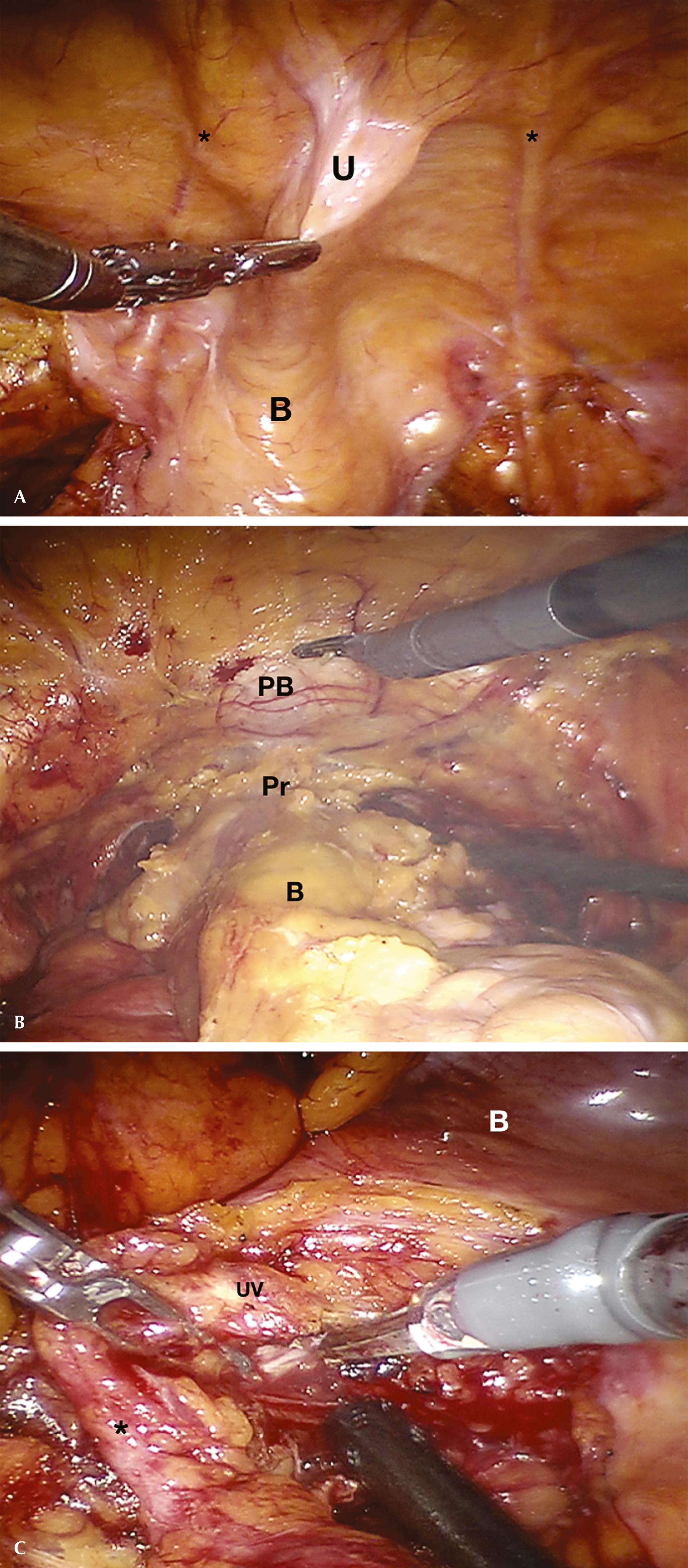 FIGURE 67.1, Bladder mobilization and dissection of ureters. ∗ (in A), Umbilical arteries; ∗ (in C), ureter; B, bladder; PB, pubic bone; Pr, prostate; U, urachus; UV, uretero-vescical junction.