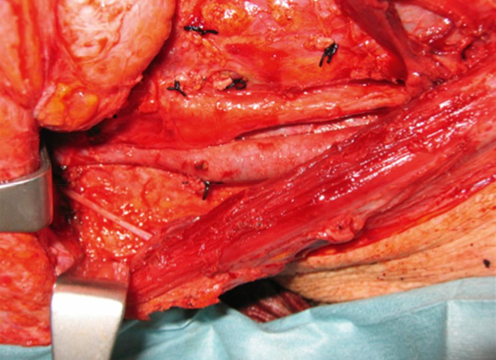 Fig. 66.2, Operative photo of right neck contents, demonstrating close association of the sternocleidomastoid muscle, internal jugular vein, and spinal accessory nerve in level II.