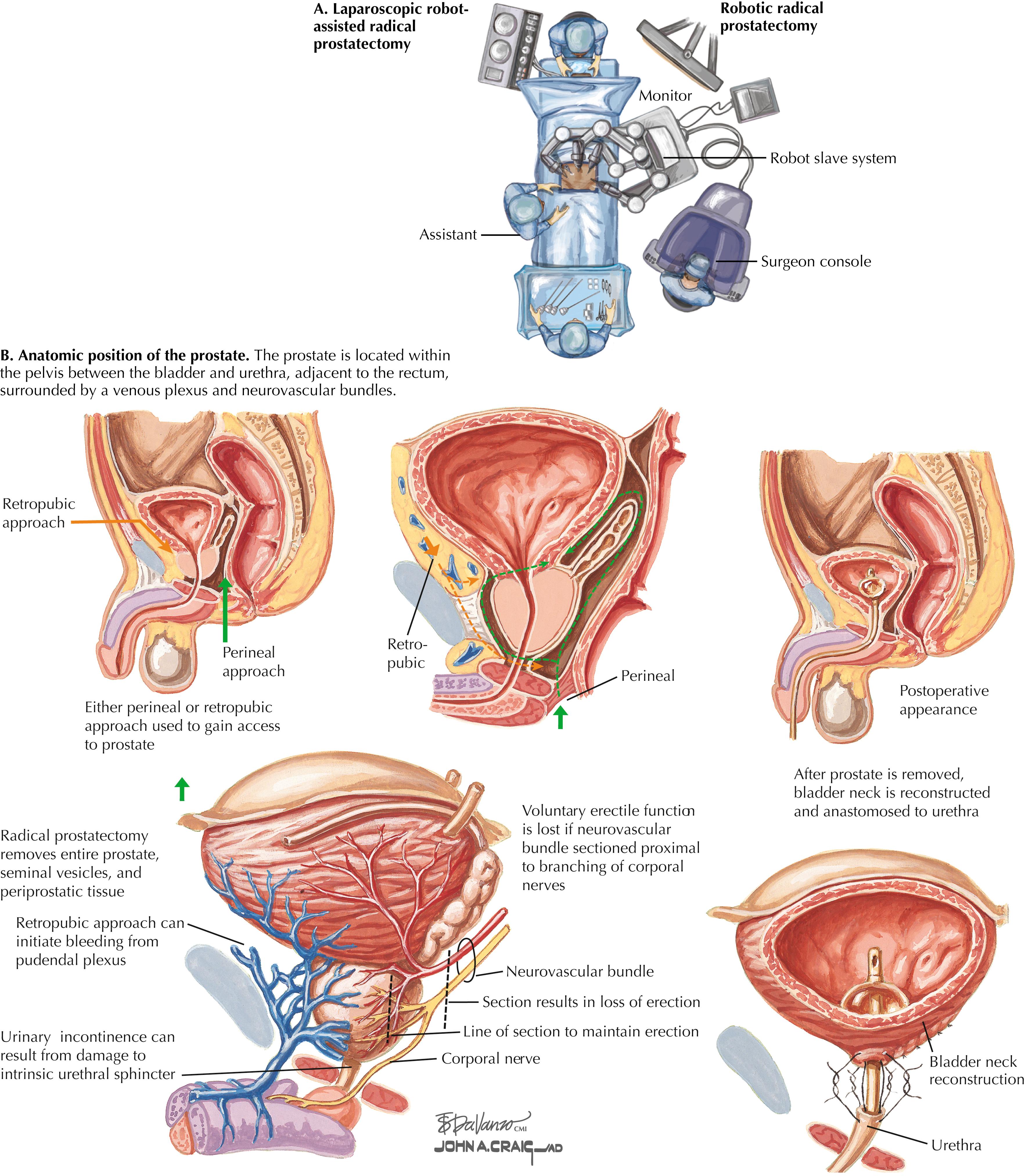 FIGURE 66.1, Robot-assisted prostatectomy and surgical approaches to prostate.