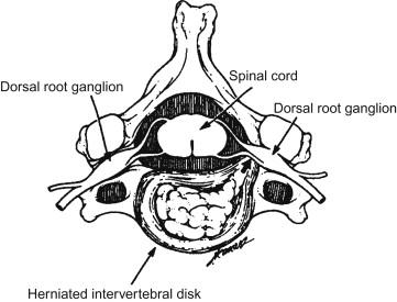 Figure 12.2, Radiculopathy with sparing of the dorsal root ganglion. Herniated invertebral discs are a common cause of cervical and lumbosacral radiculopathy. Disc herniation is most often lateral and posterior, with the dorsal root ganglion located distal to the herniation. This anatomic relationship results in injury to the roots but sparing of the dorsal root ganglion and the peripheral sensory nerves.