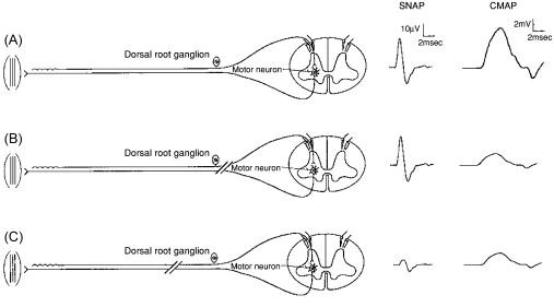 Figure 12.3, Sensory and motor potentials in axonal lesions distal and proximal to the dorsal root ganglion. (A) Normal. (B) Lesion proximal to the dorsal root ganglion. (C) Lesion distal to the dorsal root ganglion.