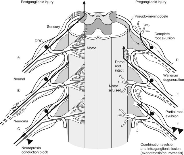 Figure 12.4, Schematic representation of the normal anatomy of and injuries to the roots of plexus, demonstrating typical preganglionic and postganglionic abnormalities. (A) Normal ventral (motor) rootlets and dorsal (sensory) rootlets. (B) Postganglionic injury (axonotmesis or neurotmesis) with neuroma formation and partial or complete disconnection of neural elements. Continuity can be determined only by intraoperative neurophysiologic studies across damaged segments. The compound muscle action potentials (CMAPs) and sensory nerve action potentials (SNAPs) from the corresponding territory will be abnormal (amplitude decreased owing to axonal loss). (C) A neurapraxic lesion resulting in abnormal sensation and weakness but normal SNAPs and CMAPs distal to the area of focal conduction block. Conduction across the segment may be blocked intraoperatively. (D) Preganglionic injury with complete avulsion and traumatic pseudomeningocele. The cell body of the sensory neuron is intact in the dorsal root ganglion; therefore, a normal SNAP is recorded in an asensate territory. CMAPs will be nonrecordable. (E) Partial root avulsion with dorsal root intact and ventral (motor) root avulsed. This produces weakness and normal sensation and a normal SNAP with absent or abnormal CMAPs in respective segmental distribution. (F) Combination of a preganglionic and postganglionic lesion, which often can be determined only intraoperatively and correlated with imaging. The roots (motor and sensory) have been avulsed, but the infraganglionic component is also abnormal (axonotmesis–neurotmesis), similar to B . Therefore, the SNAPs and CMAPs are absent or abnormal. This can mislead the electromyographer into thinking that the lesion is purely infraganglionic, and he or she might miss the preganglionic injury.